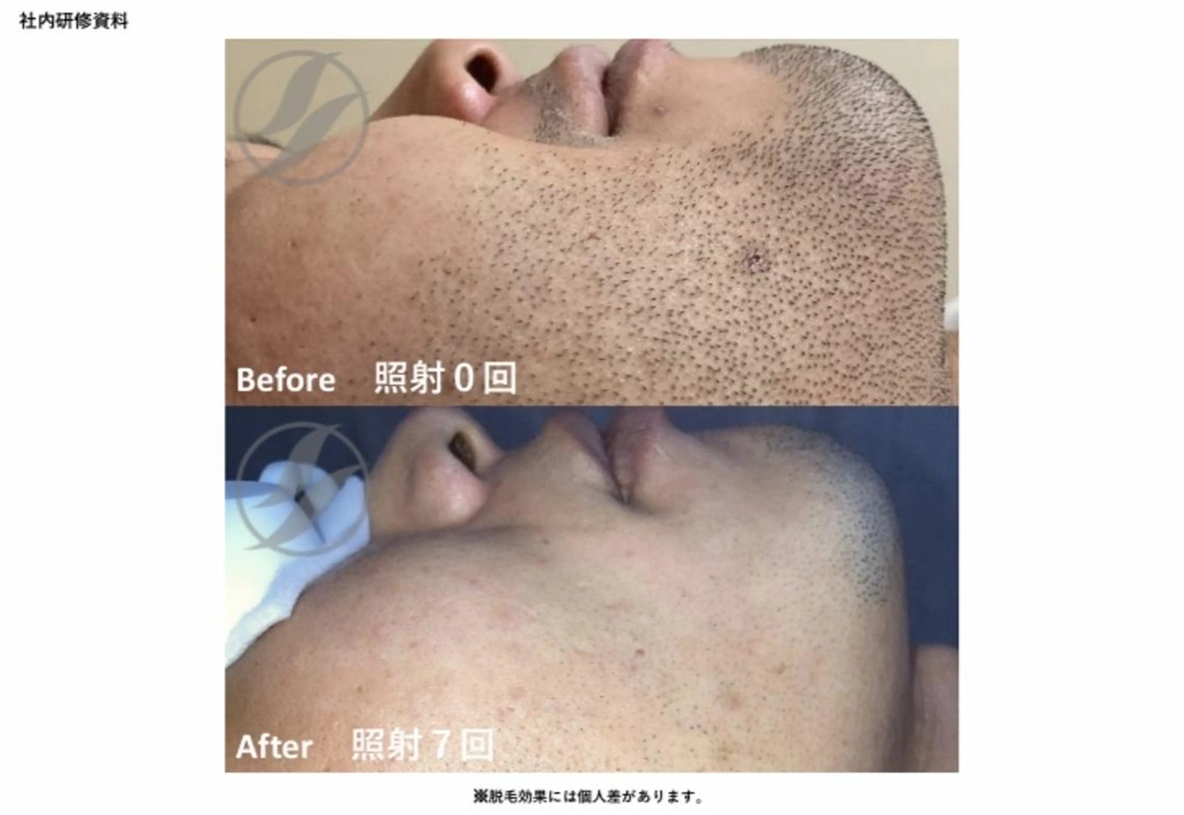 メンズ 脱毛 noel de mi 前川亜里沙のエステ・リラクイメージ