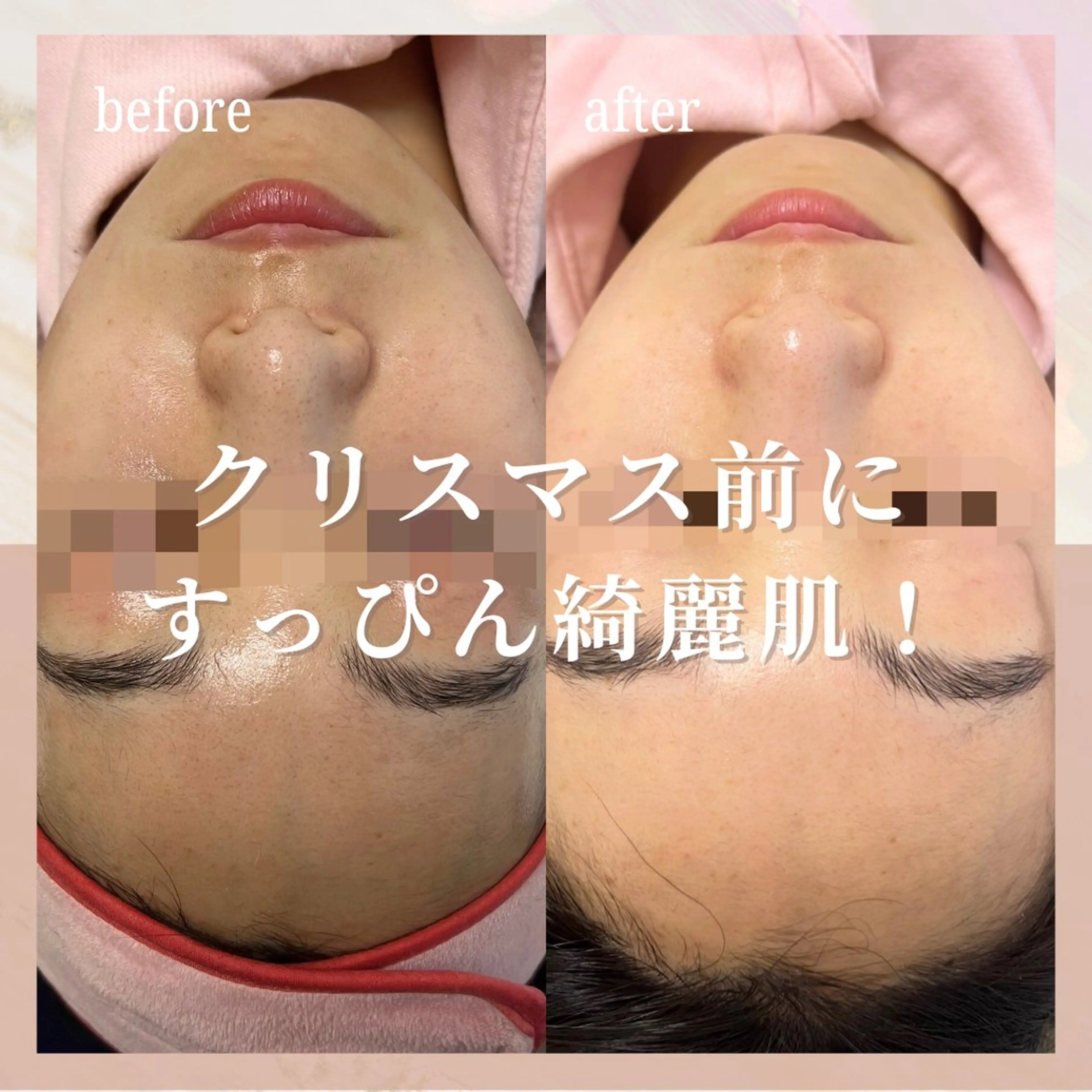 エステ 🎀韓国式肌改善🎀 Miku🇰🇷💎のその他イメージ