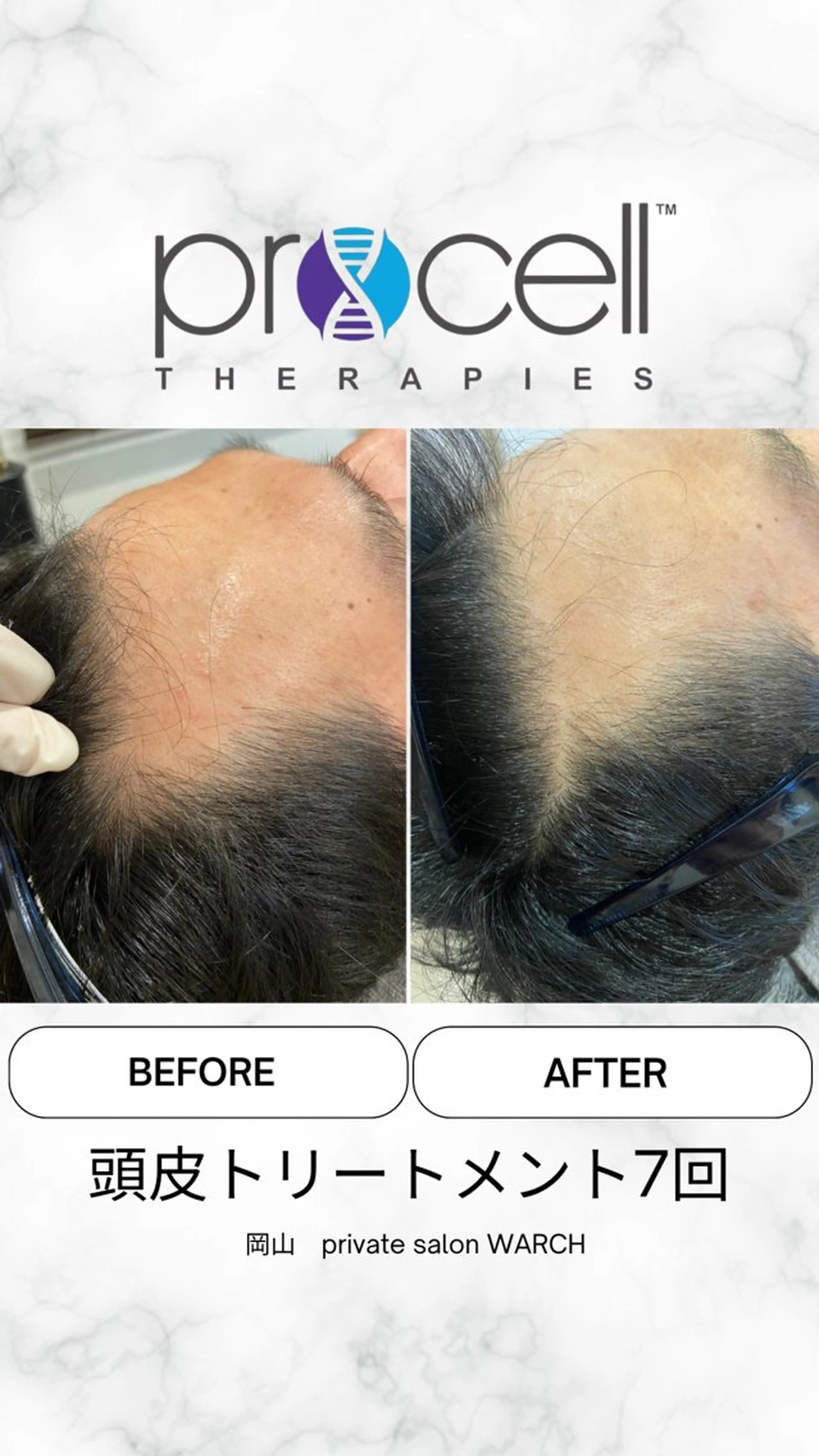 【本気の育毛促進】プロセル頭皮（M字、生え際）￥50,000→￥40,000の写真
