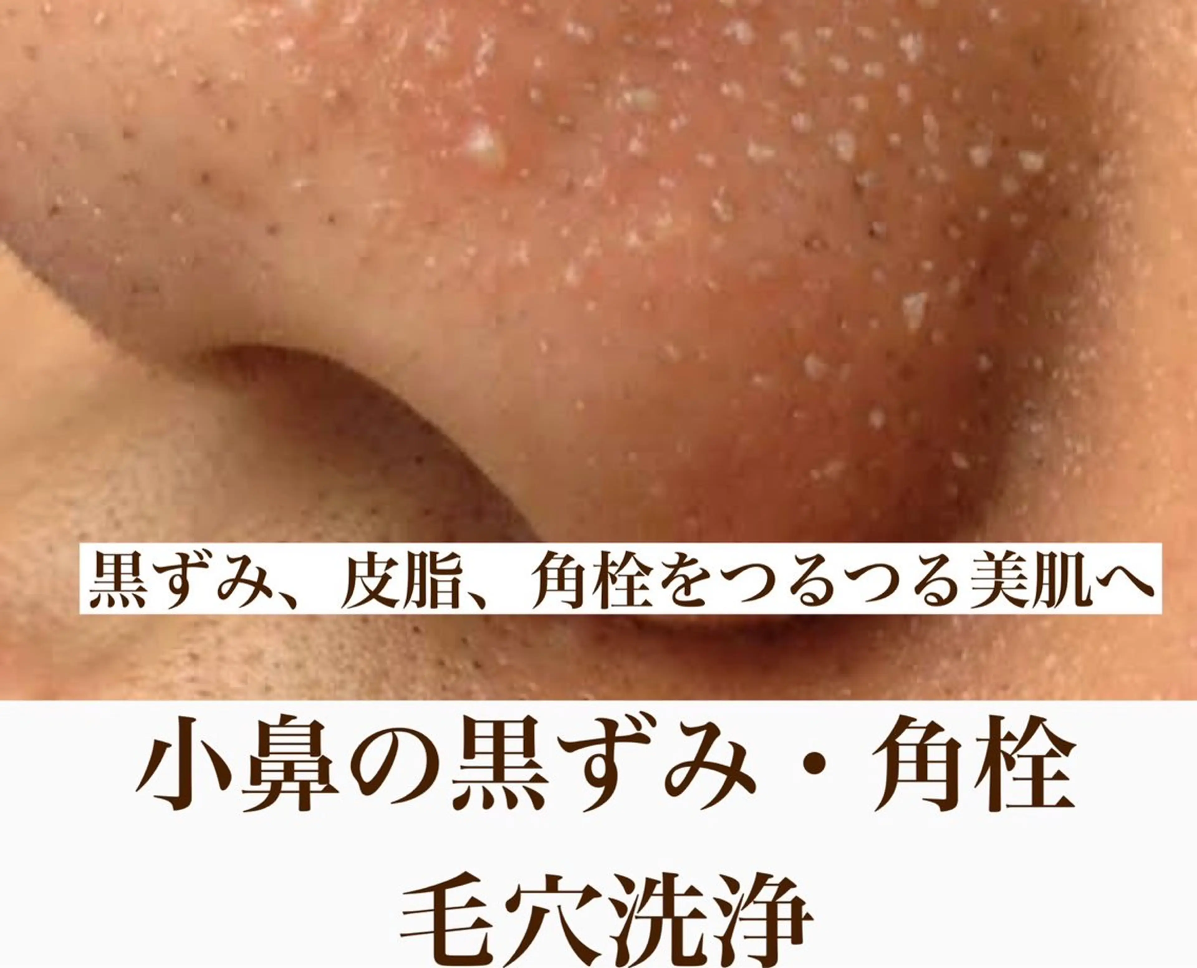 【皮脂ケア・黒ずみ対策・イチゴ鼻】毛穴のお掃除フェイシャル！の写真