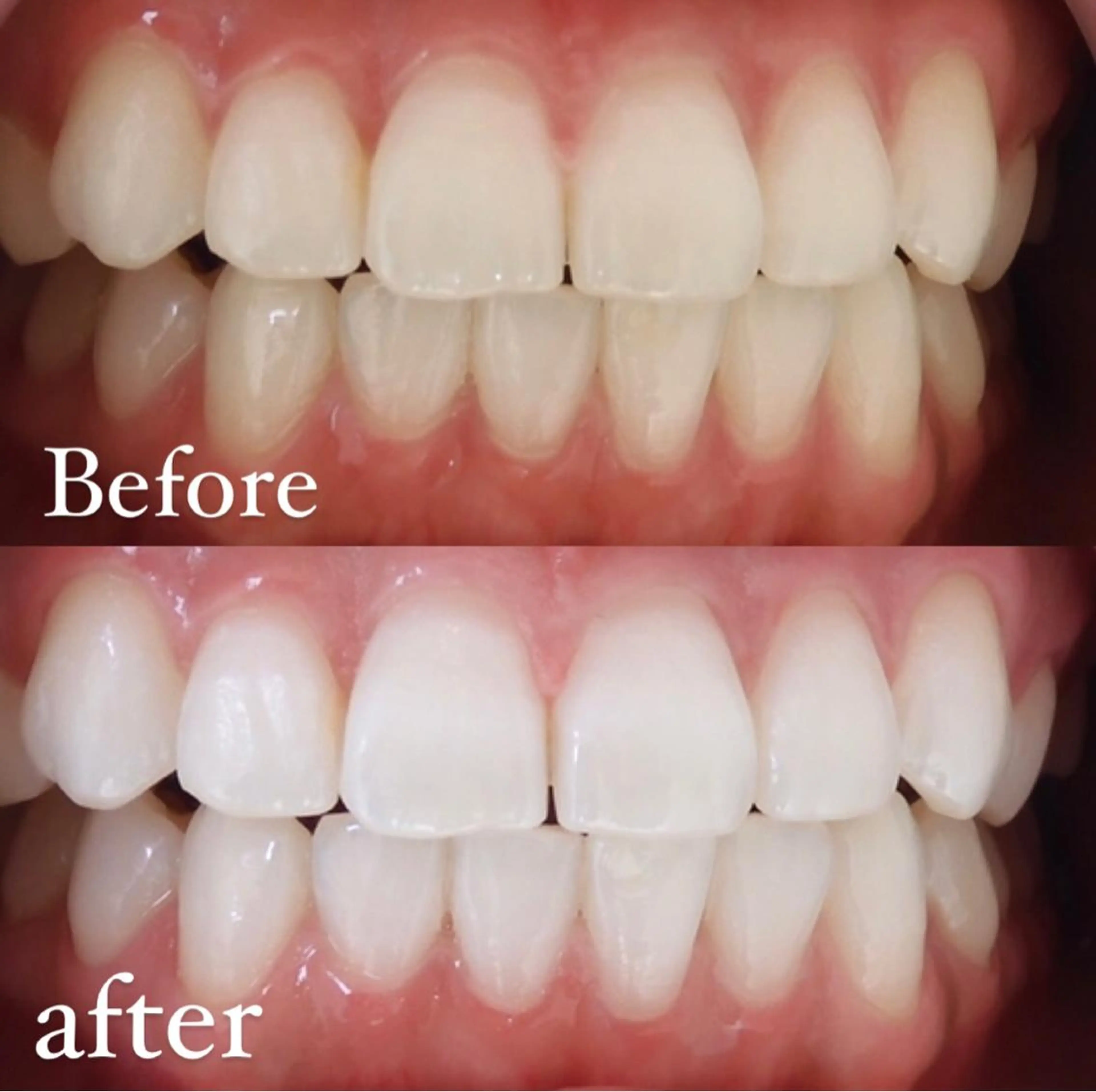 🦷基本セルフホワイトニングコース🦷【8分×2】の写真