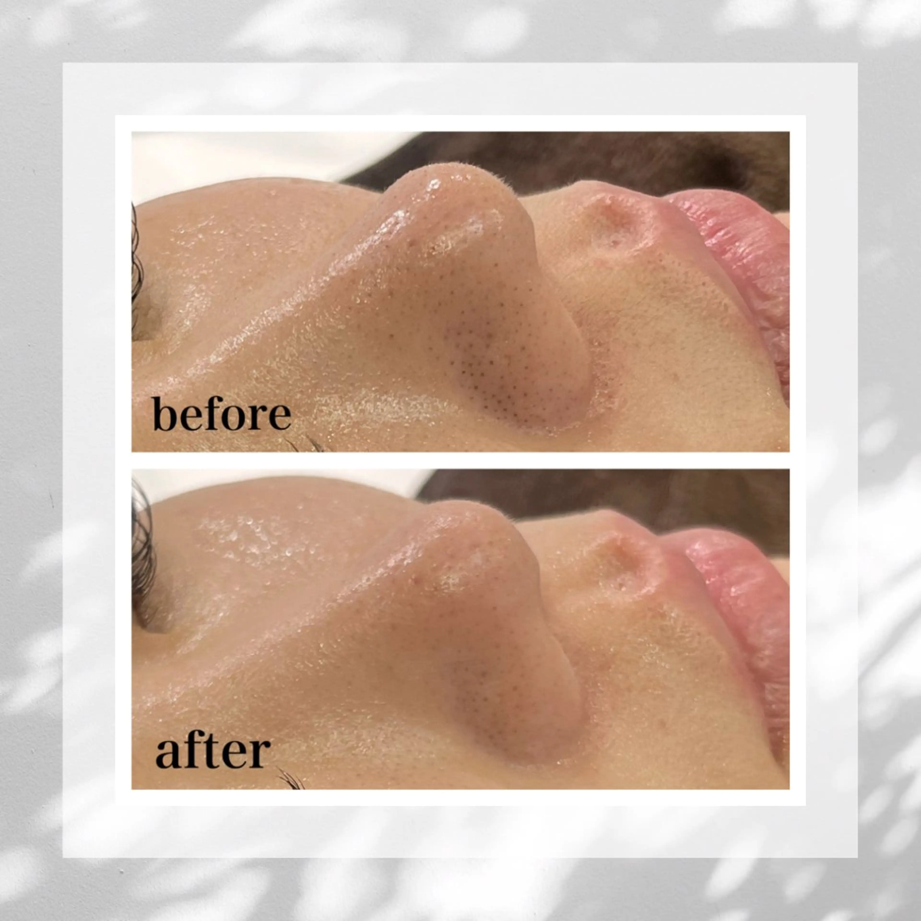 1日1名【いちご鼻/黒ずみから卒業したい方限定】Tゾーン毛穴洗浄お試し30分の写真