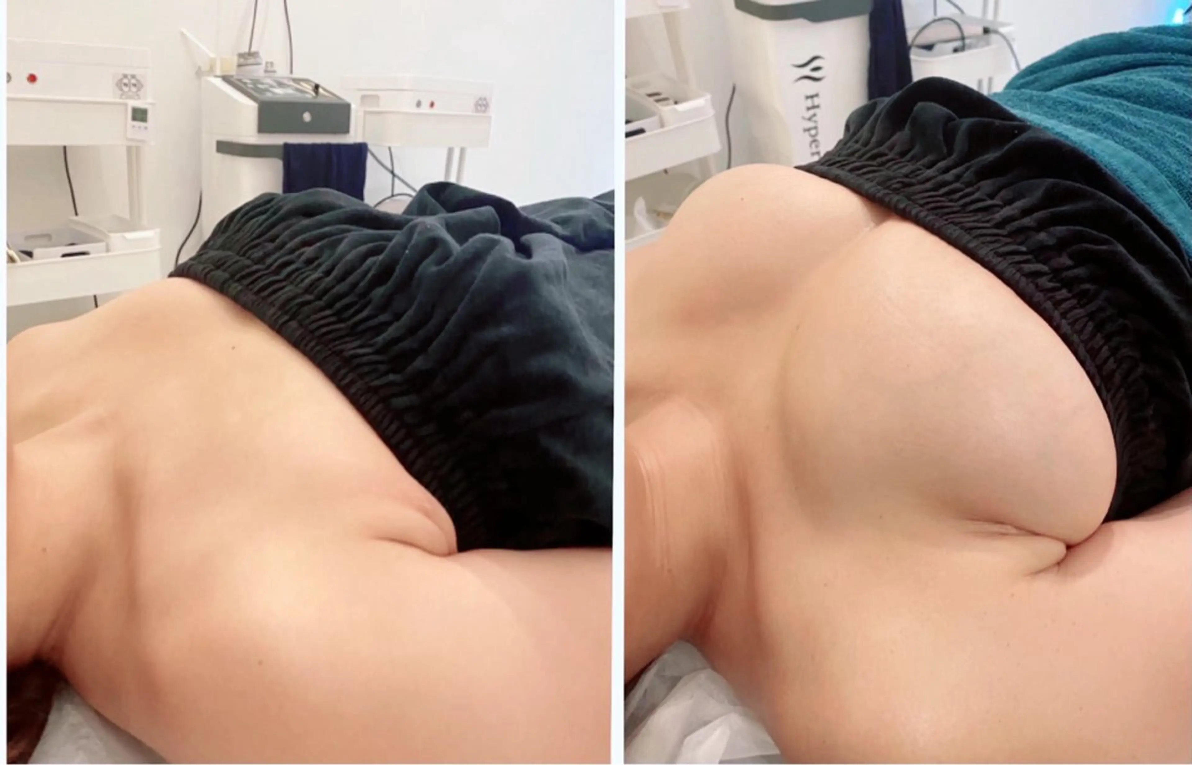 光豊胸バストアップコース👙❤️純国産最高級バストアップマシン使用！！✨自信が持てる張りのあるバストに！！の写真