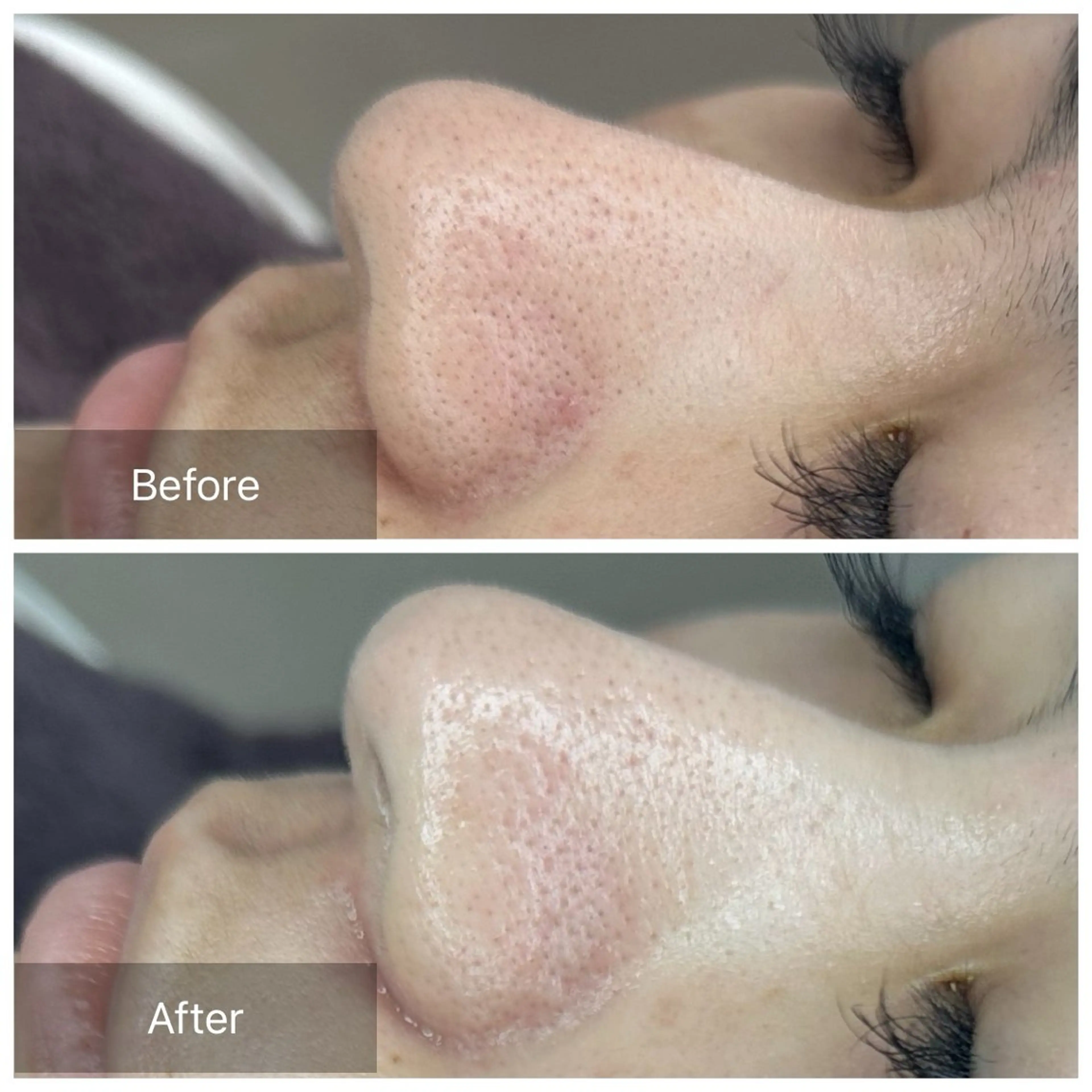 毛穴！黒ずみ！とにかく毛穴無くしたい人👸🏻💕フェイスワックス🫧（シートパック付／高保湿モデリングパック変更可）の写真