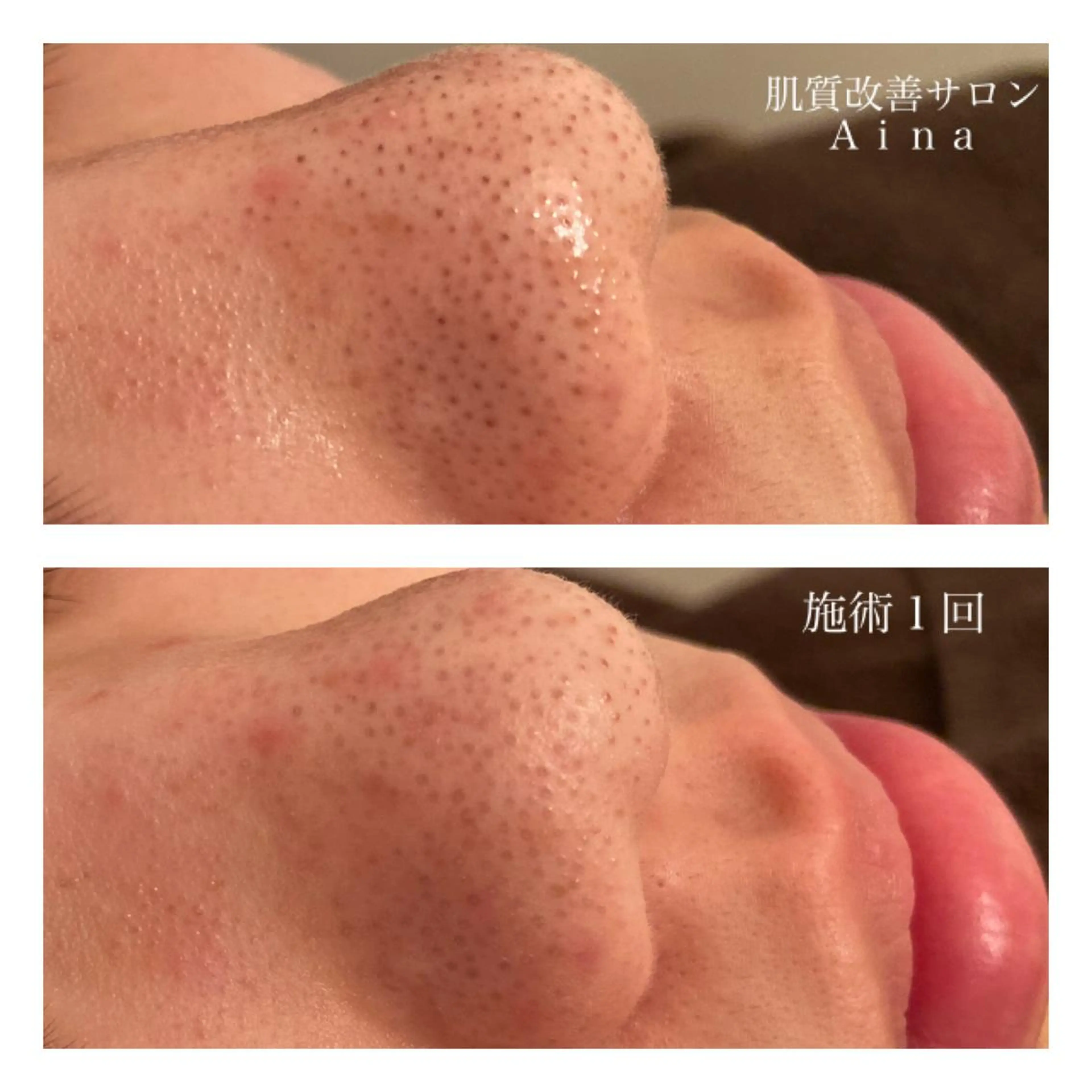 ミディアム カラー パーマ ヘアアレンジ メンズ キッズ ネイル マツエク・マツパ トリートメント ニキビ跡専門サロン Ainaのエステ・リラクイメージ