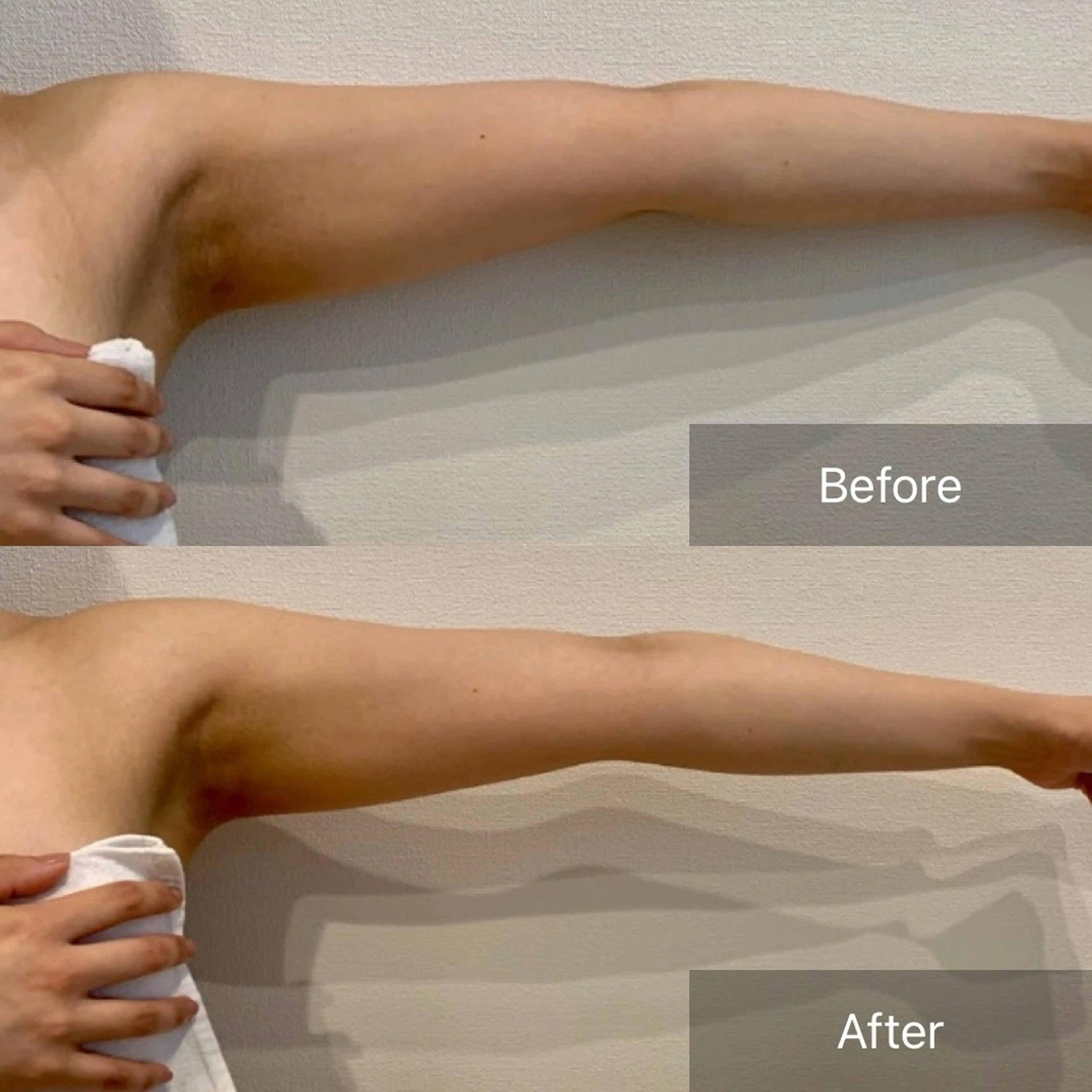 【二の腕/肩周り】WINBACK華奢見え集中ケア🌿60分　¥16,000→の写真