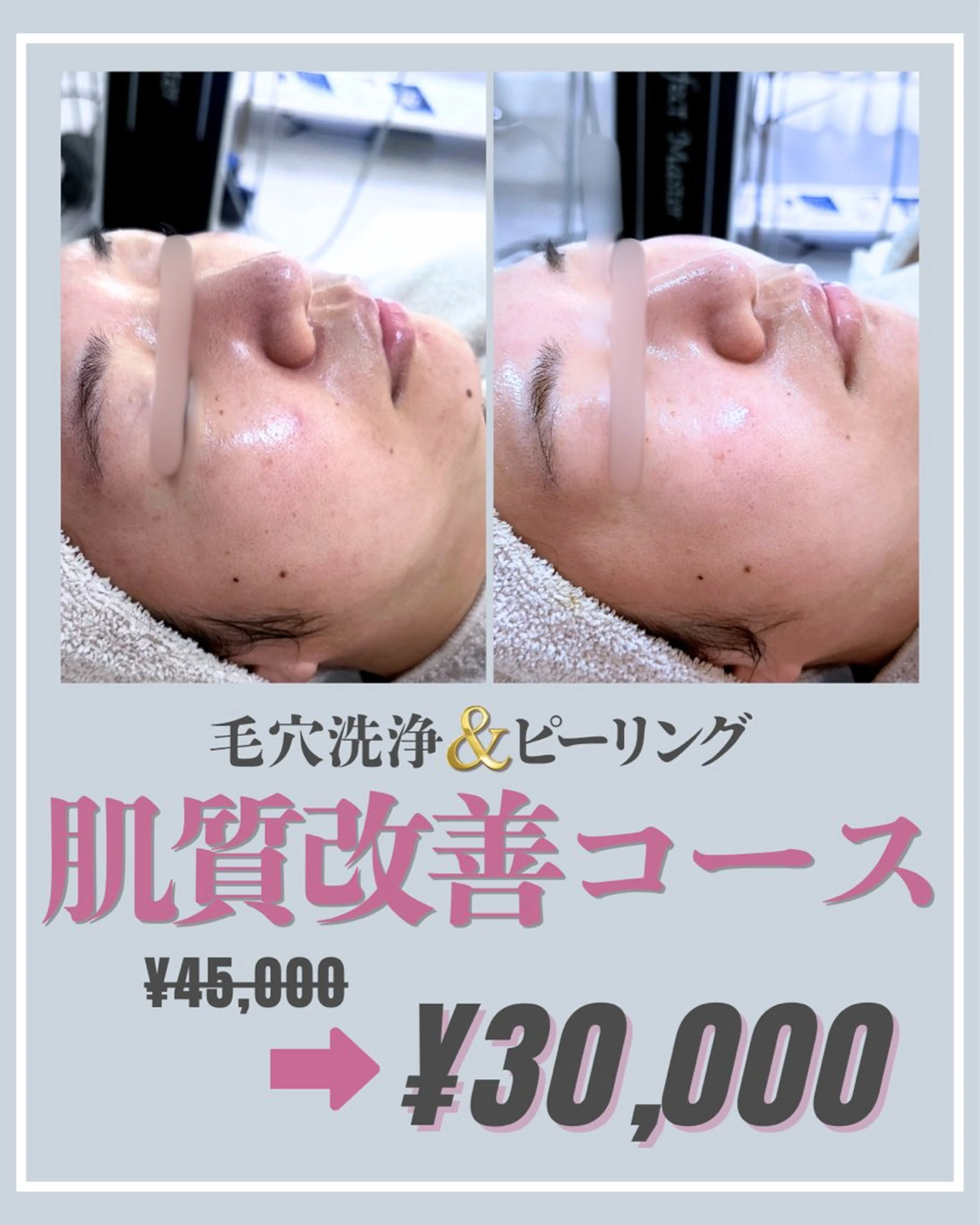 〈🎀超お得🫧〉本気の‼️肌質改善コース🫧(毛穴洗浄+ピーリング) 〈3回分🪽〉の写真