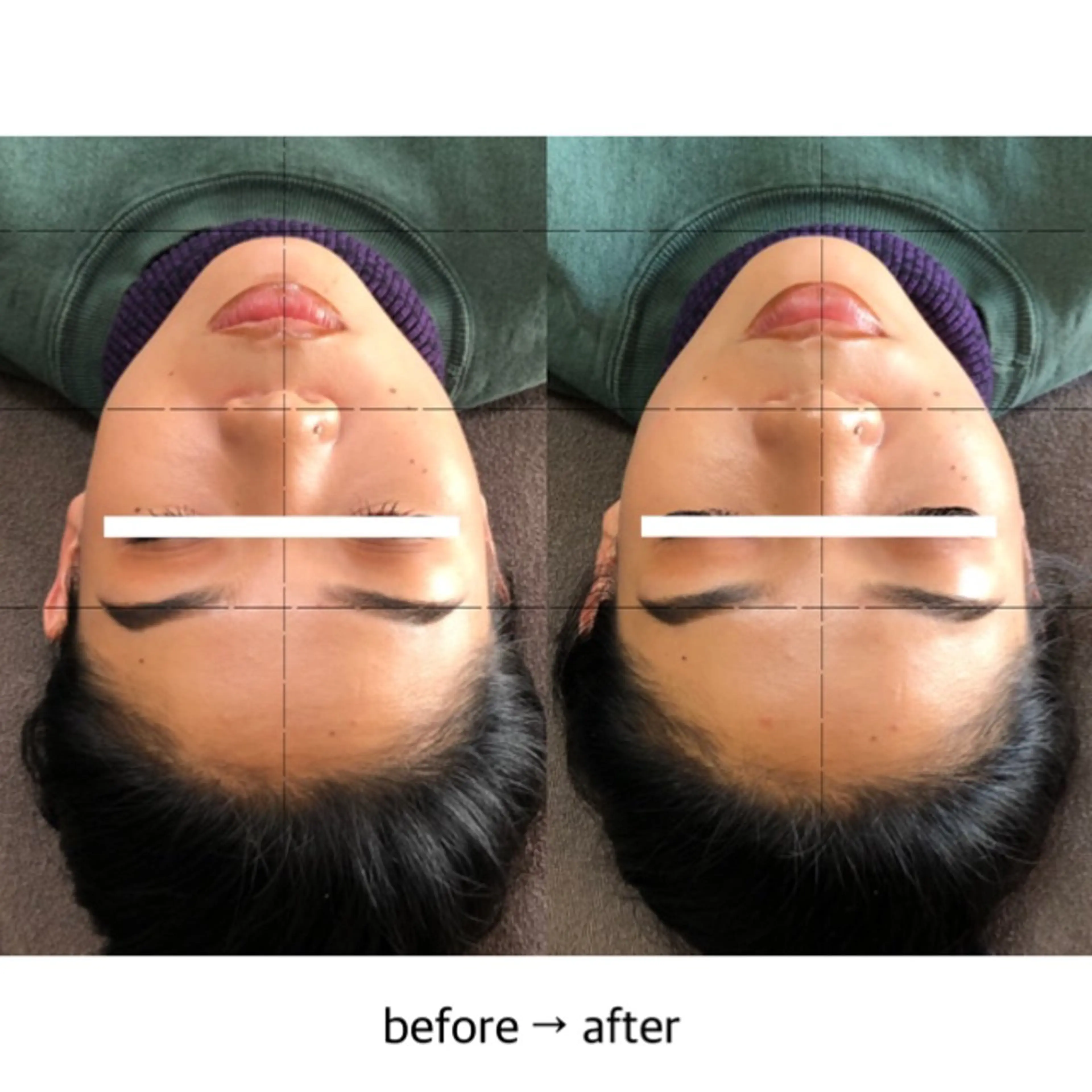 THE  ROOTS所属・美容鍼♡小顔矯正♡ fumikaのエステ・リラクイメージ