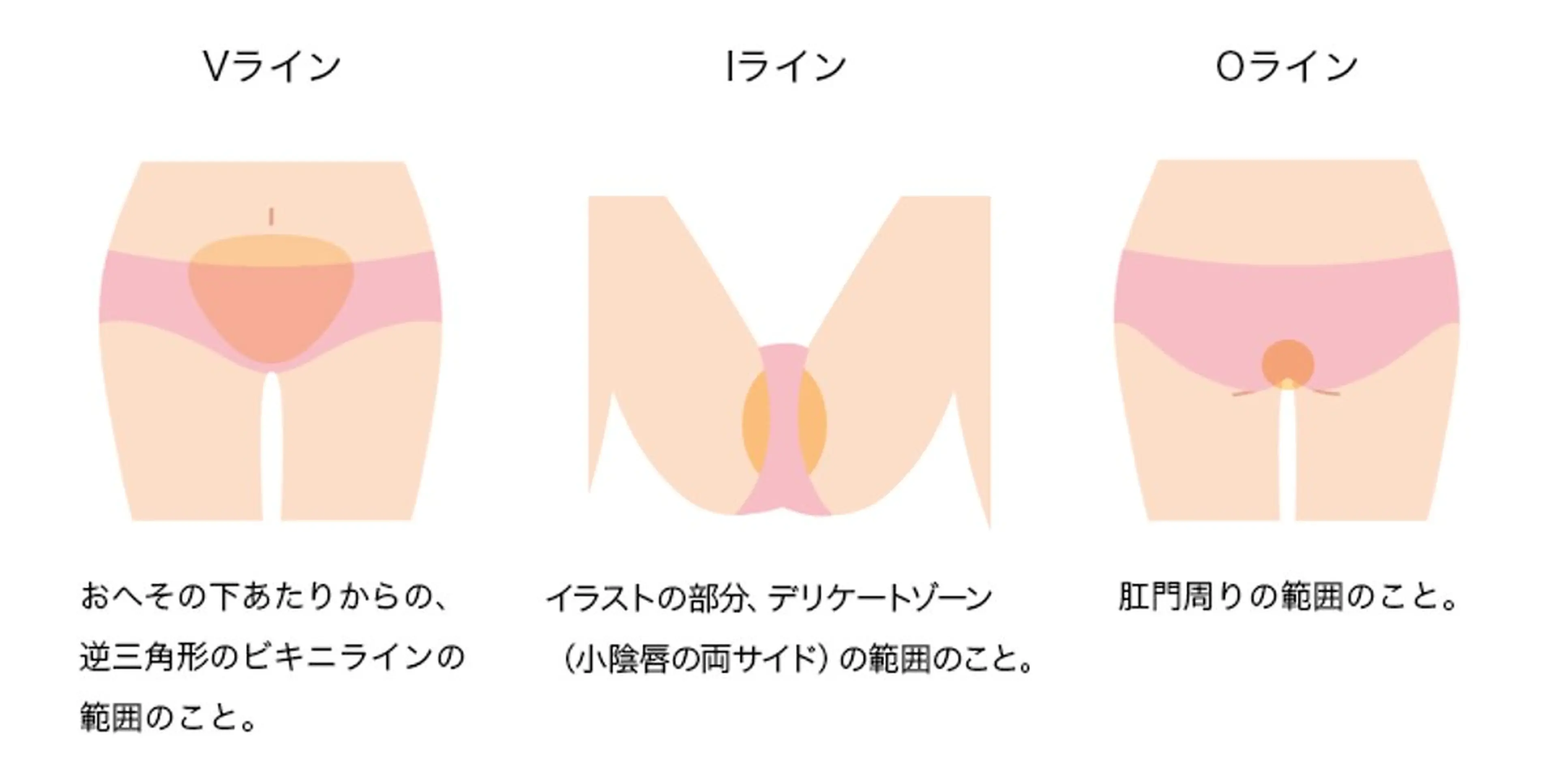 高速美肌脱毛ー女性VIOセット脱毛、痛みが少ないの写真