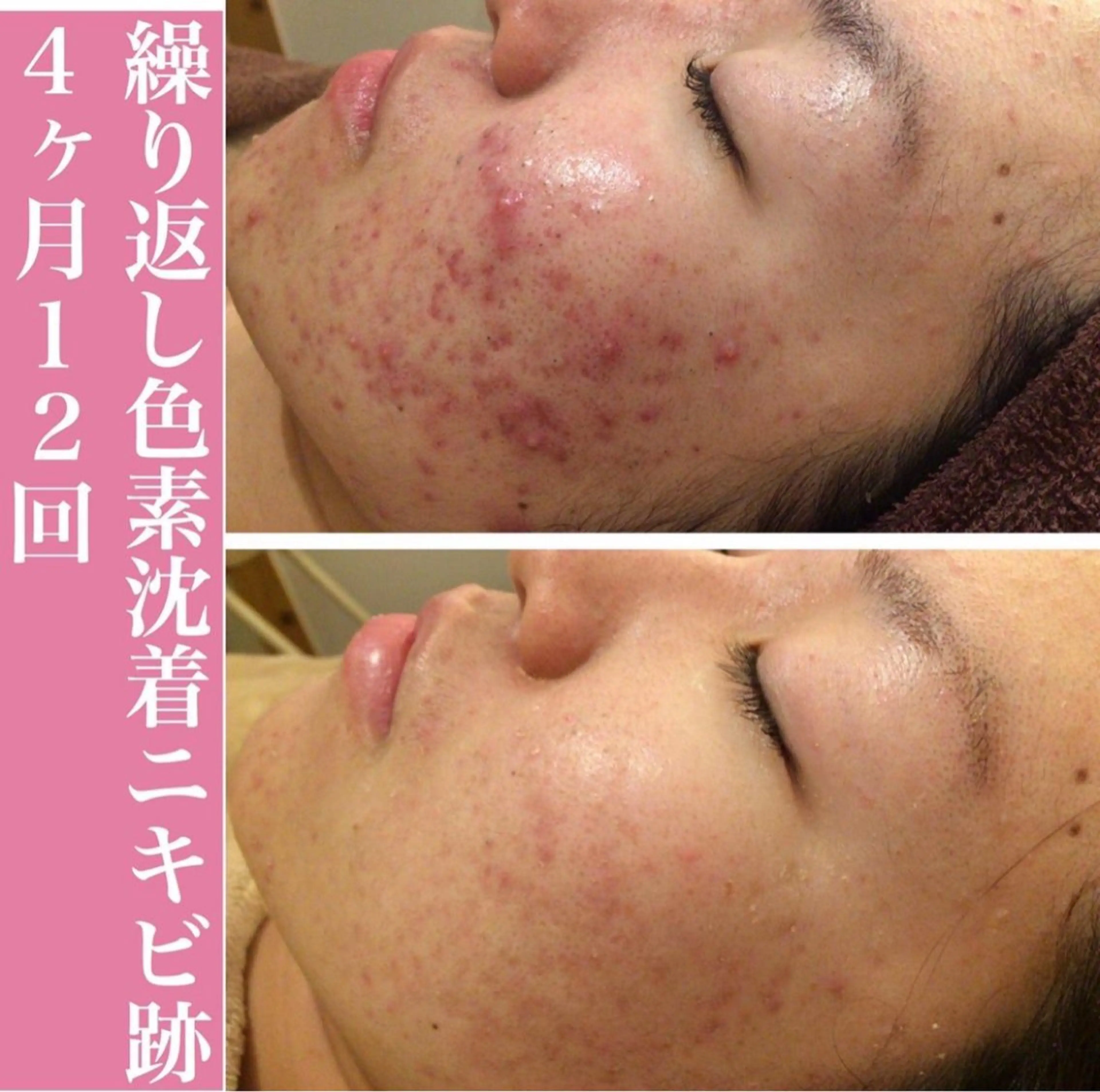 学生ニキビ改善🍀 優しい肌質改善のエステ・リラクイメージ