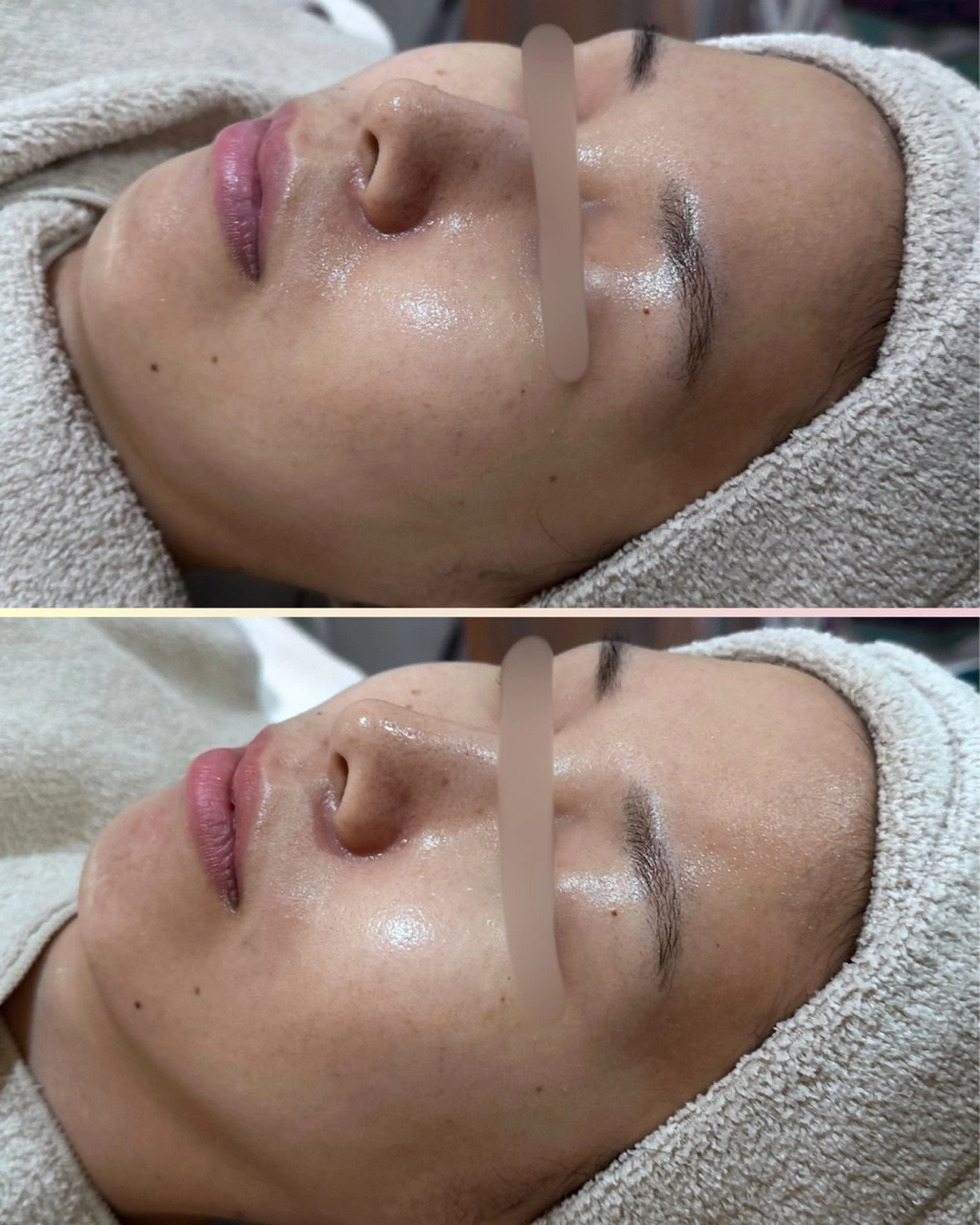 エステ |ピーリング・毛穴| soina神楽坂のエステ・リラクイメージ