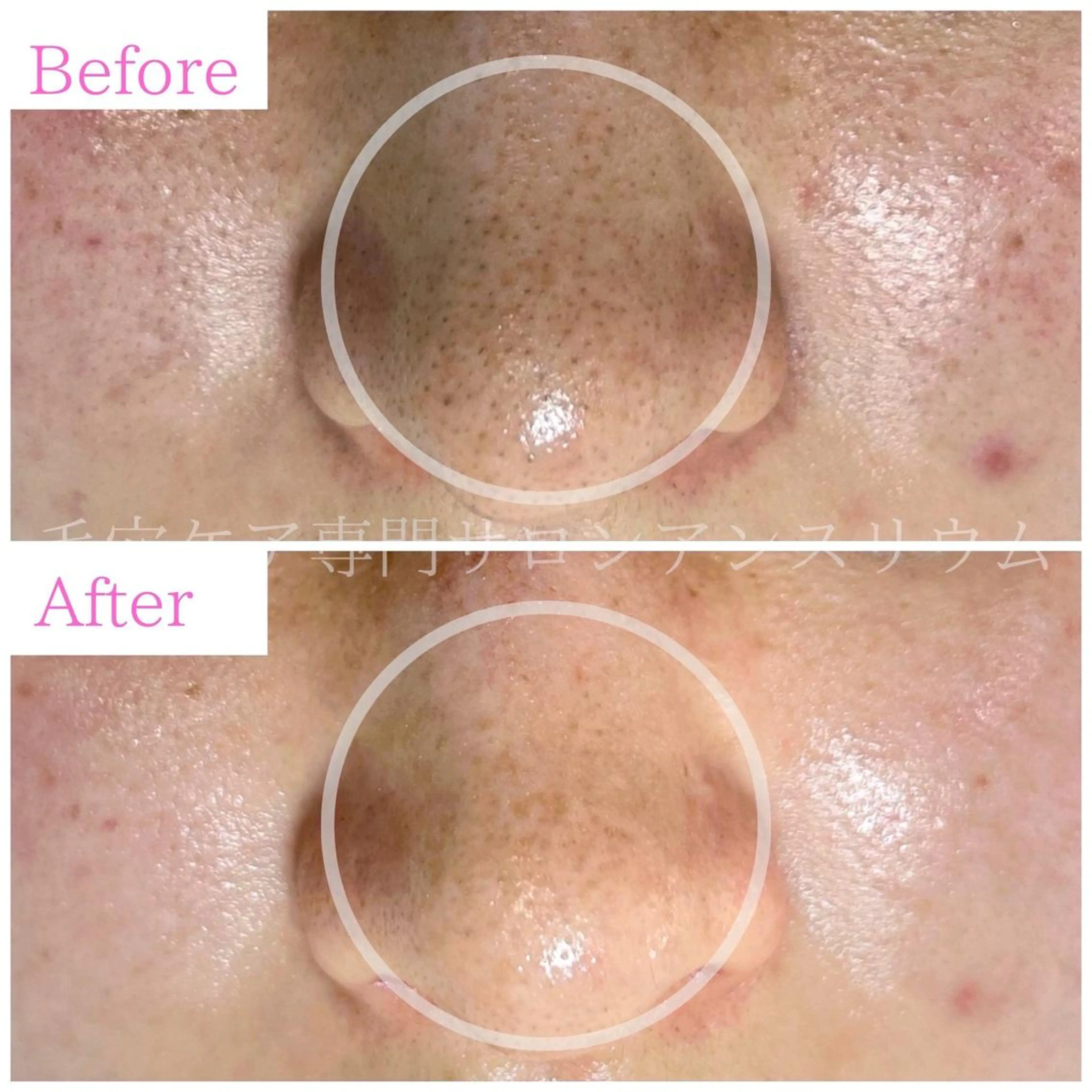 毛穴ケア専門サロンアンスリウム所属・茨城土浦 つくば毛穴 ケア専門サロンのエステ・リラクイメージ