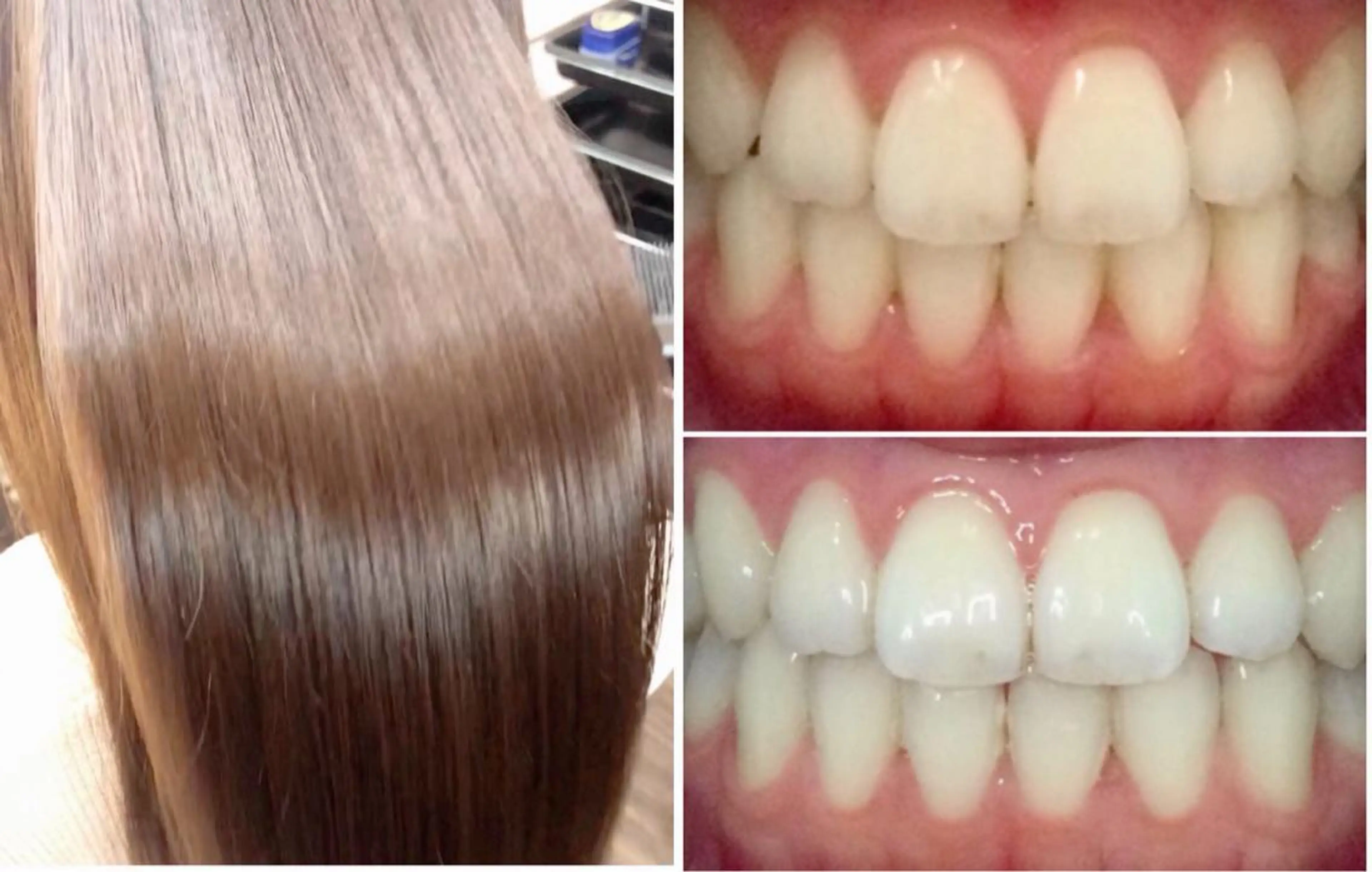 大人気🧚🧚1度で白さが2​〜​5トーンアップ✨💫美歯セルフホワイトニング30分照射➕髪質改善超音波トリートメントの写真