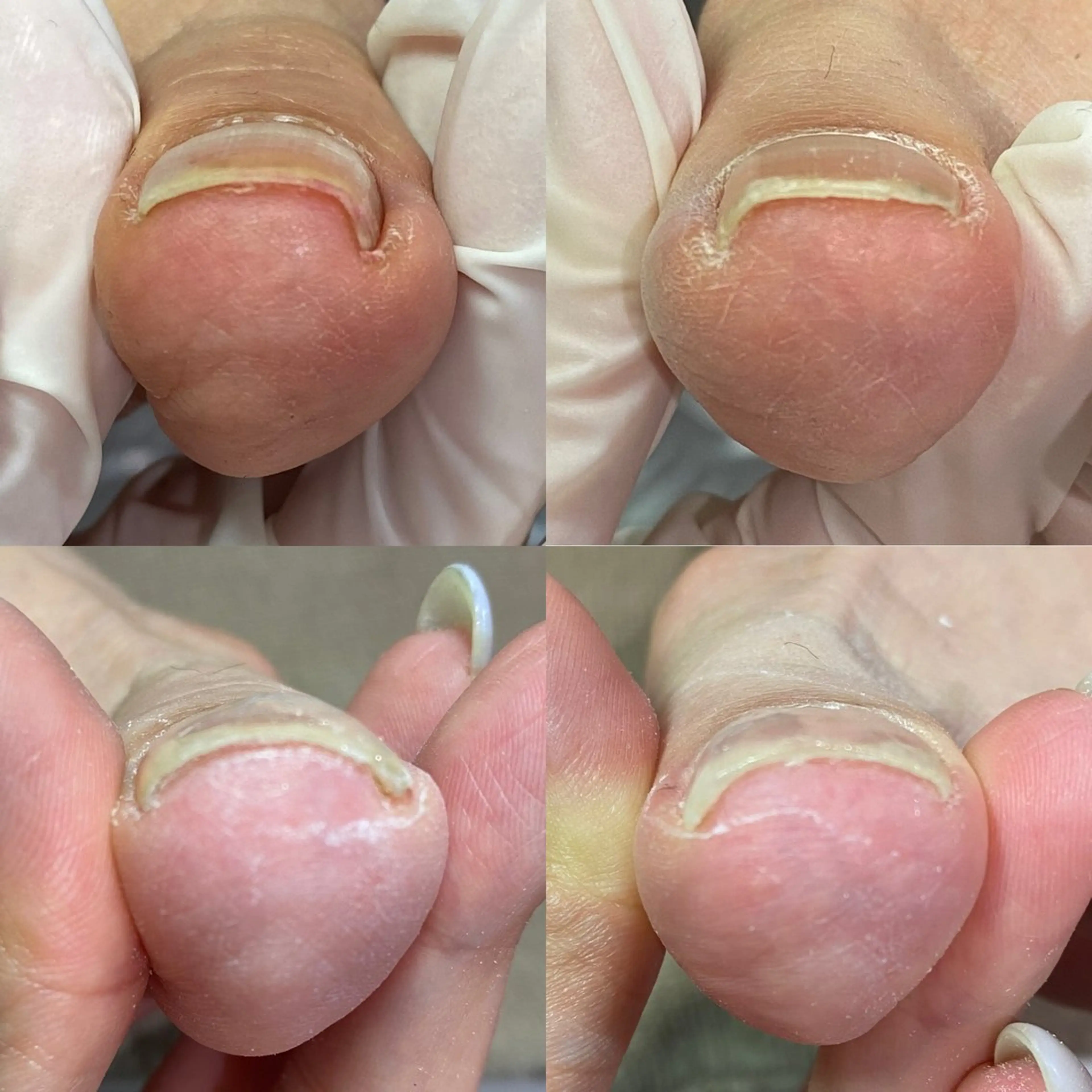 【初回カウンセリング無料】フット巻き爪補正(1ヶ所)の写真