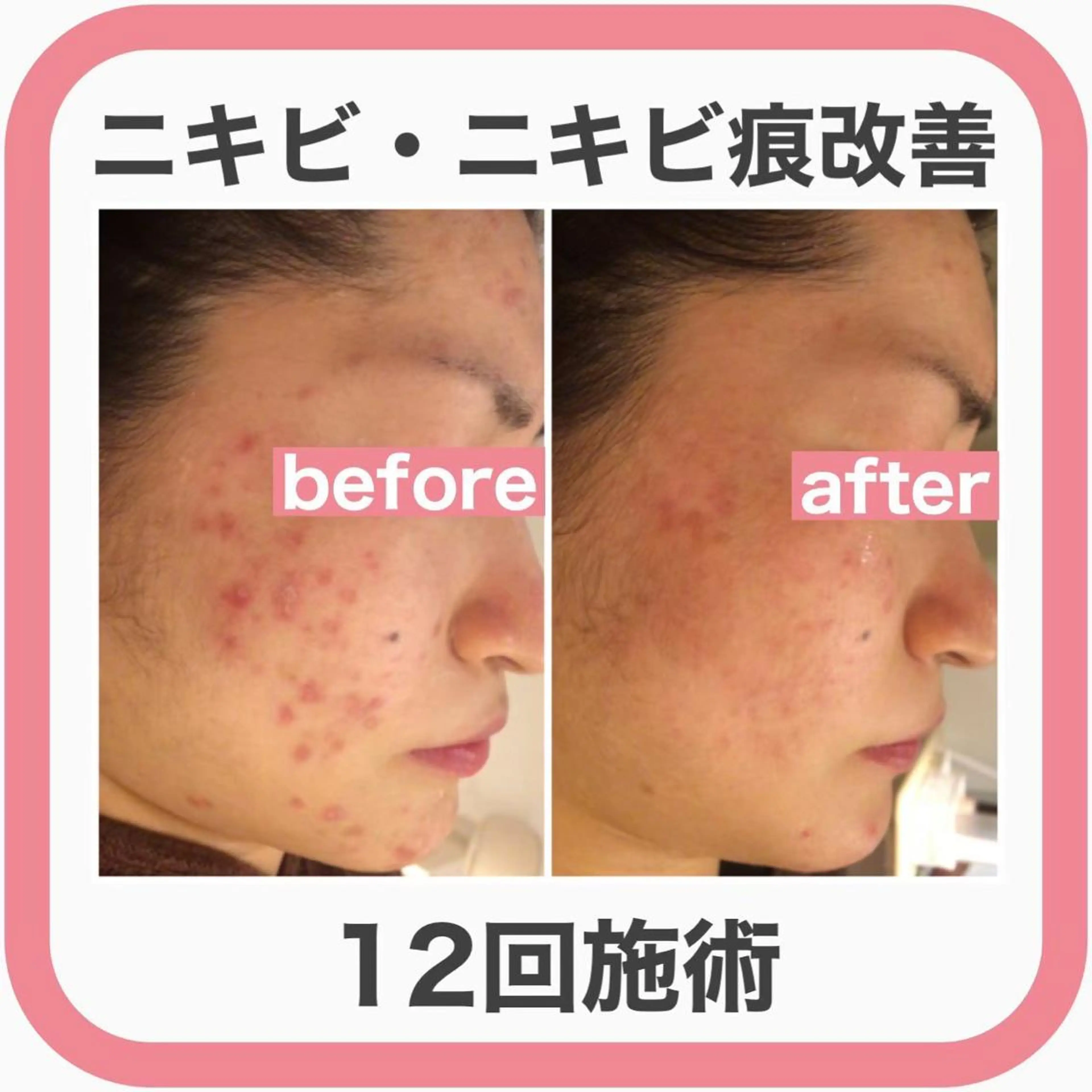 ニキビ跡改善専門🔥 医療にはできない改善のエステ・リラクイメージ