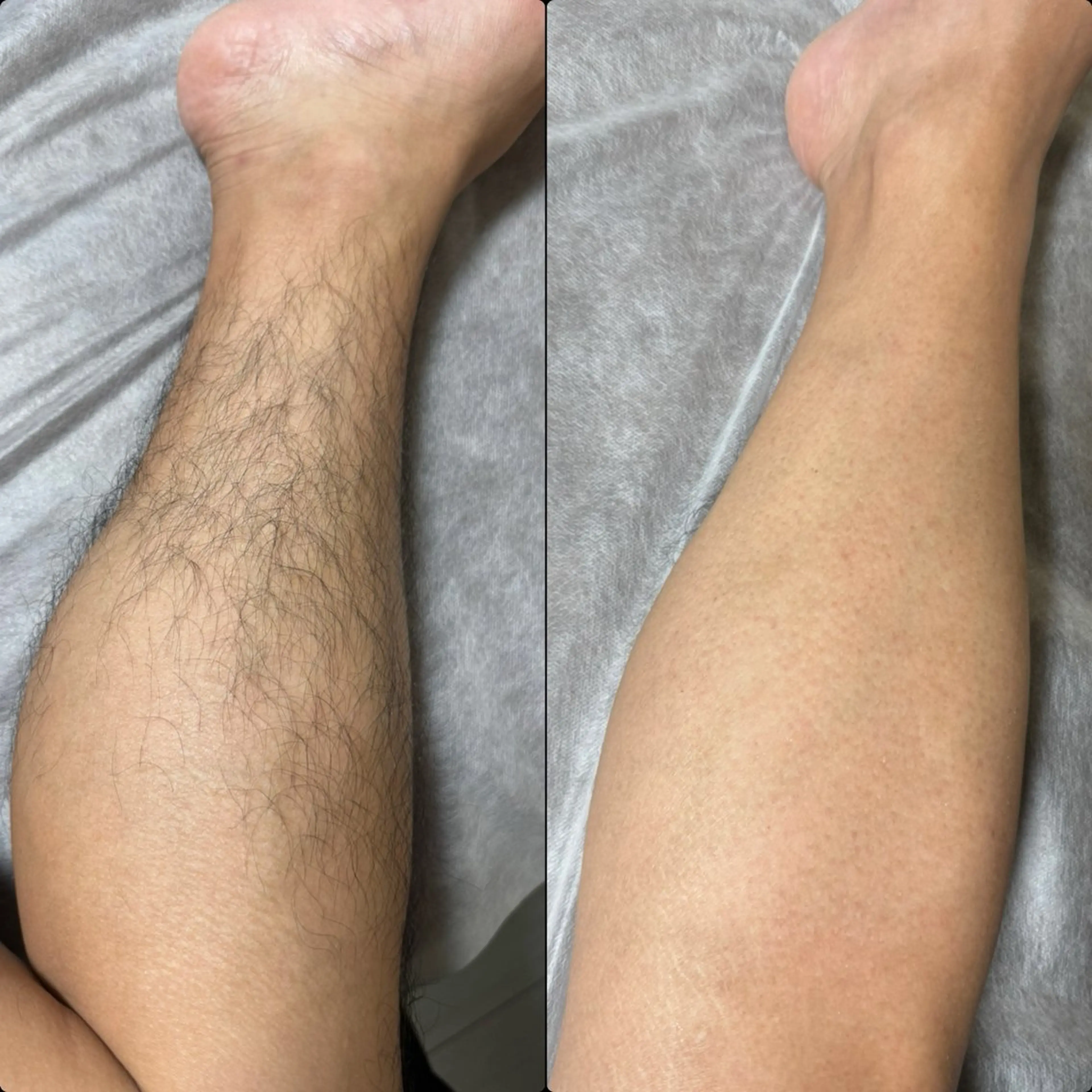 【男性】短パン男子人気No.1️⃣💫面倒な自己処理無しで🆗✨足オールブラジリアンワックス脱毛🦵¥11,300の写真