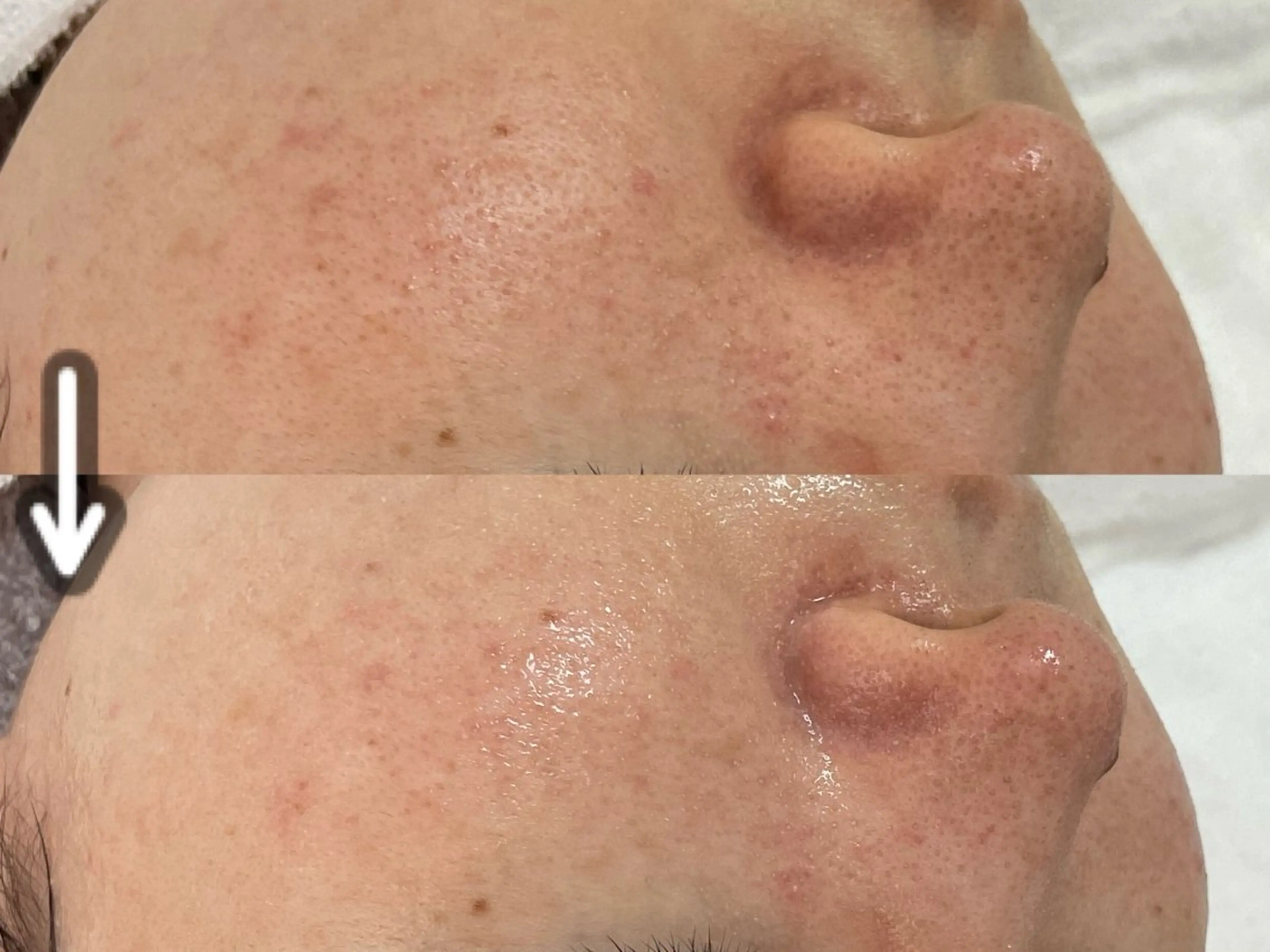 【ミニモ学割】ハーブピーリング🌿+毛穴洗浄🫧毛穴詰まりやニキビ肌にの写真