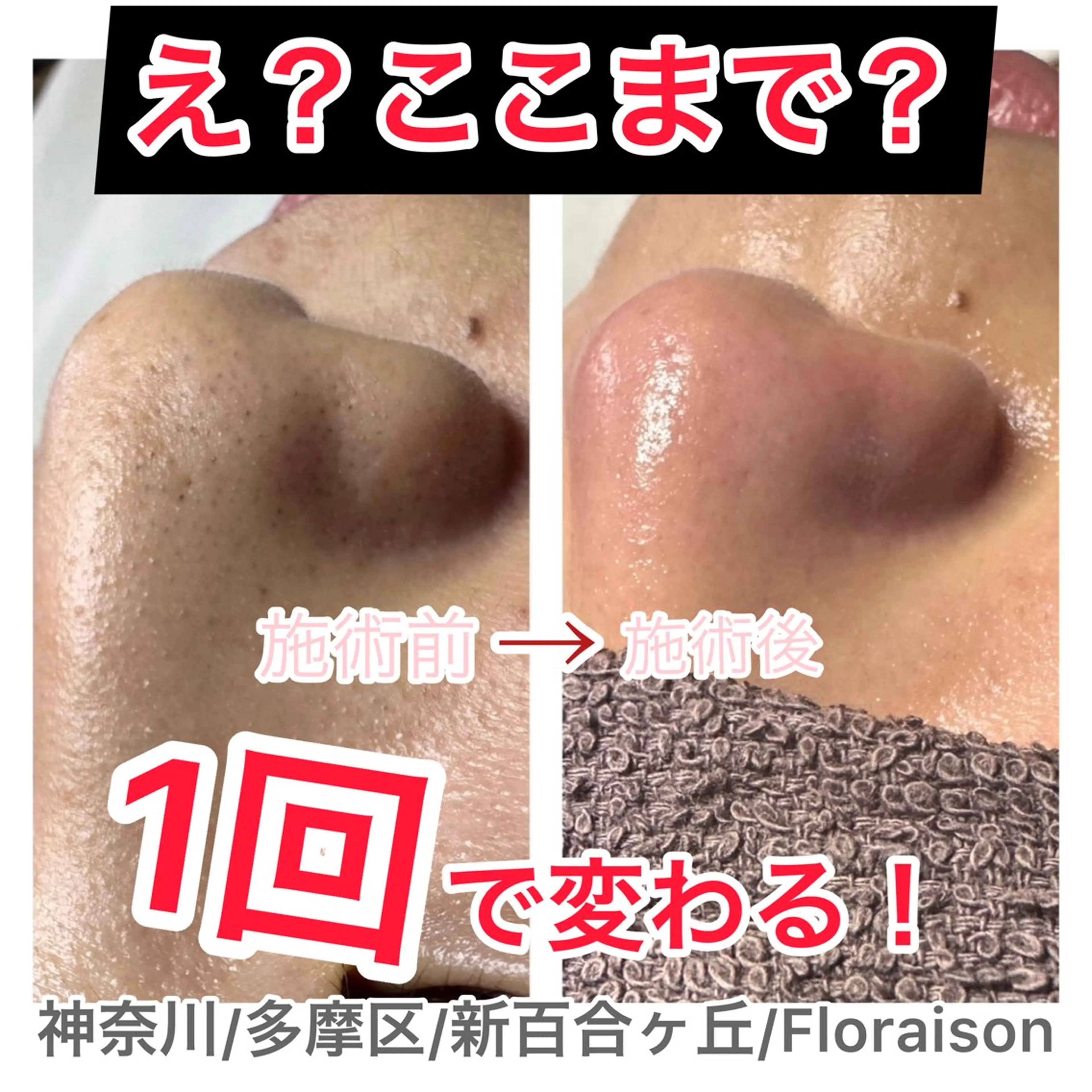 エクストラクションで毛穴レス👃の写真