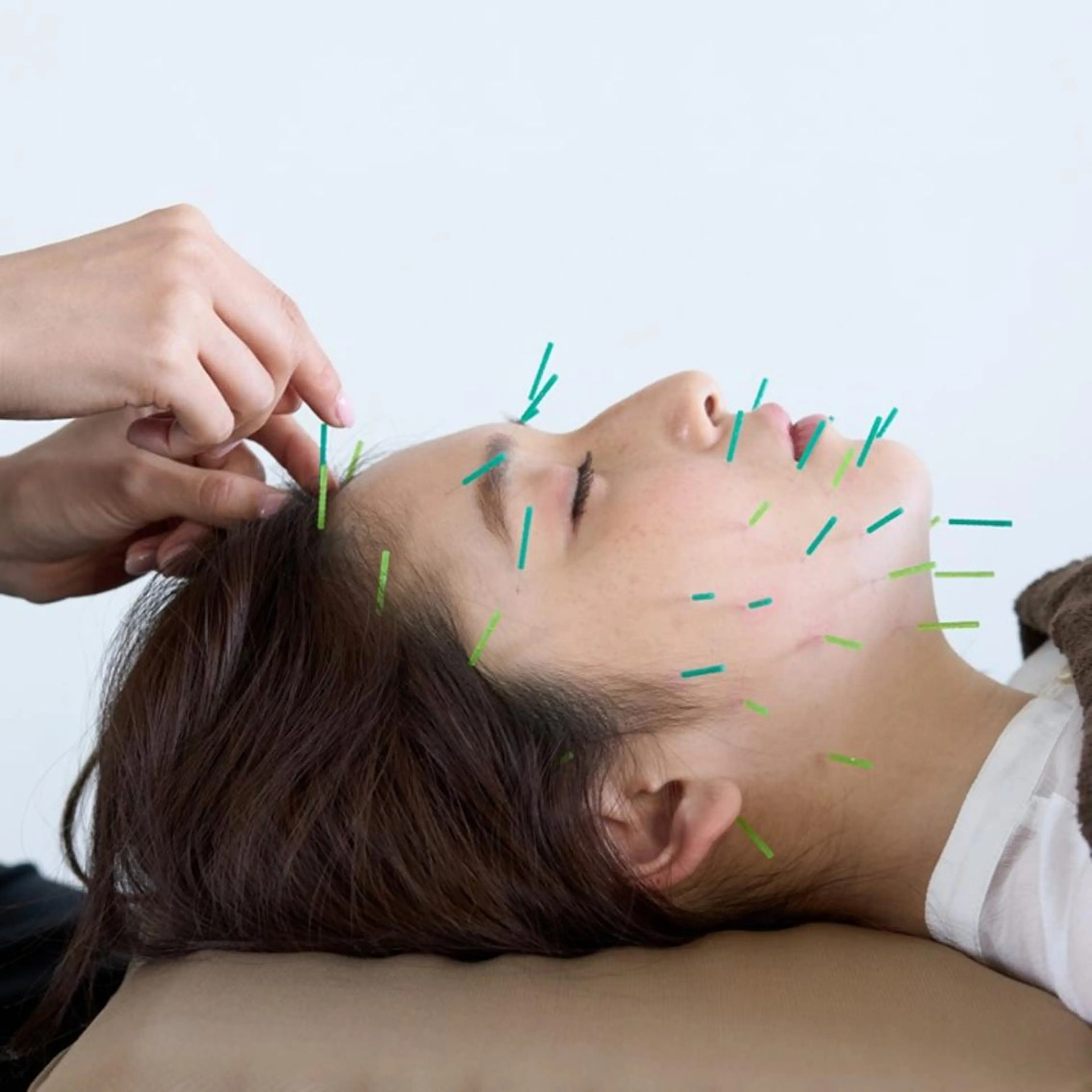 【Special】美容鍼80本＋小顔マッサージ＋保湿仕上げの写真