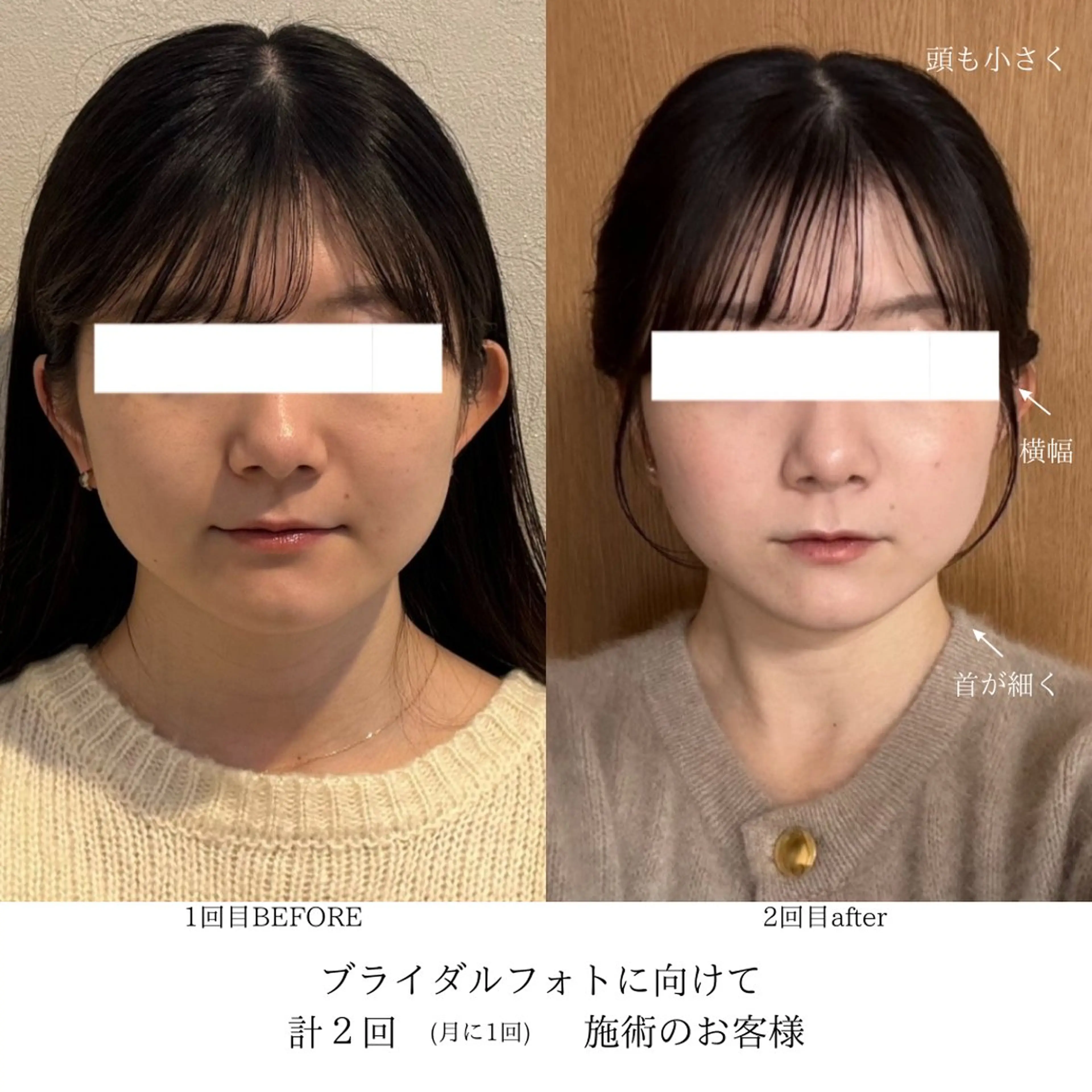 【ブライダルに向けた定着】miélu式小顔 90minの写真