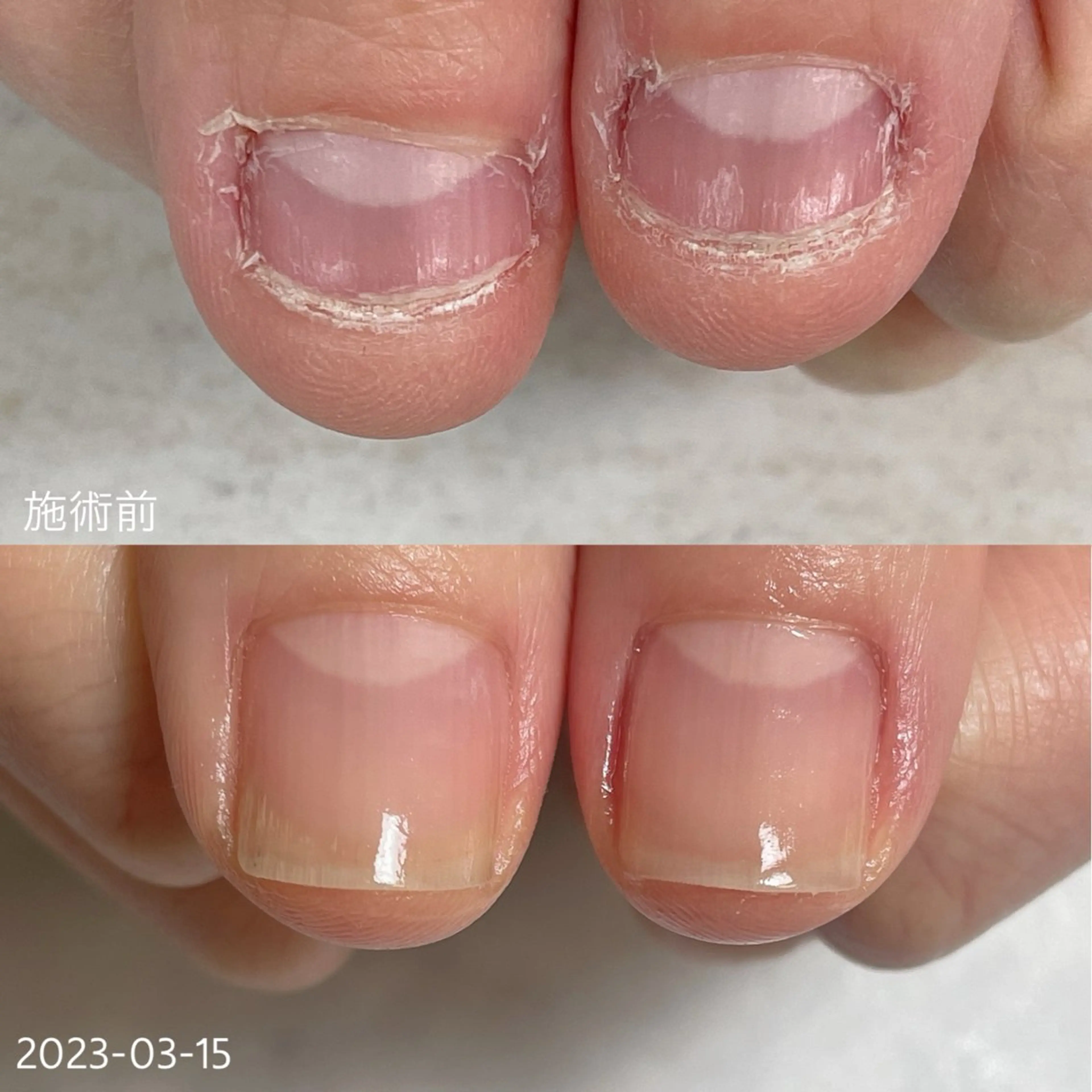 最強のネイルケア１回体験の写真