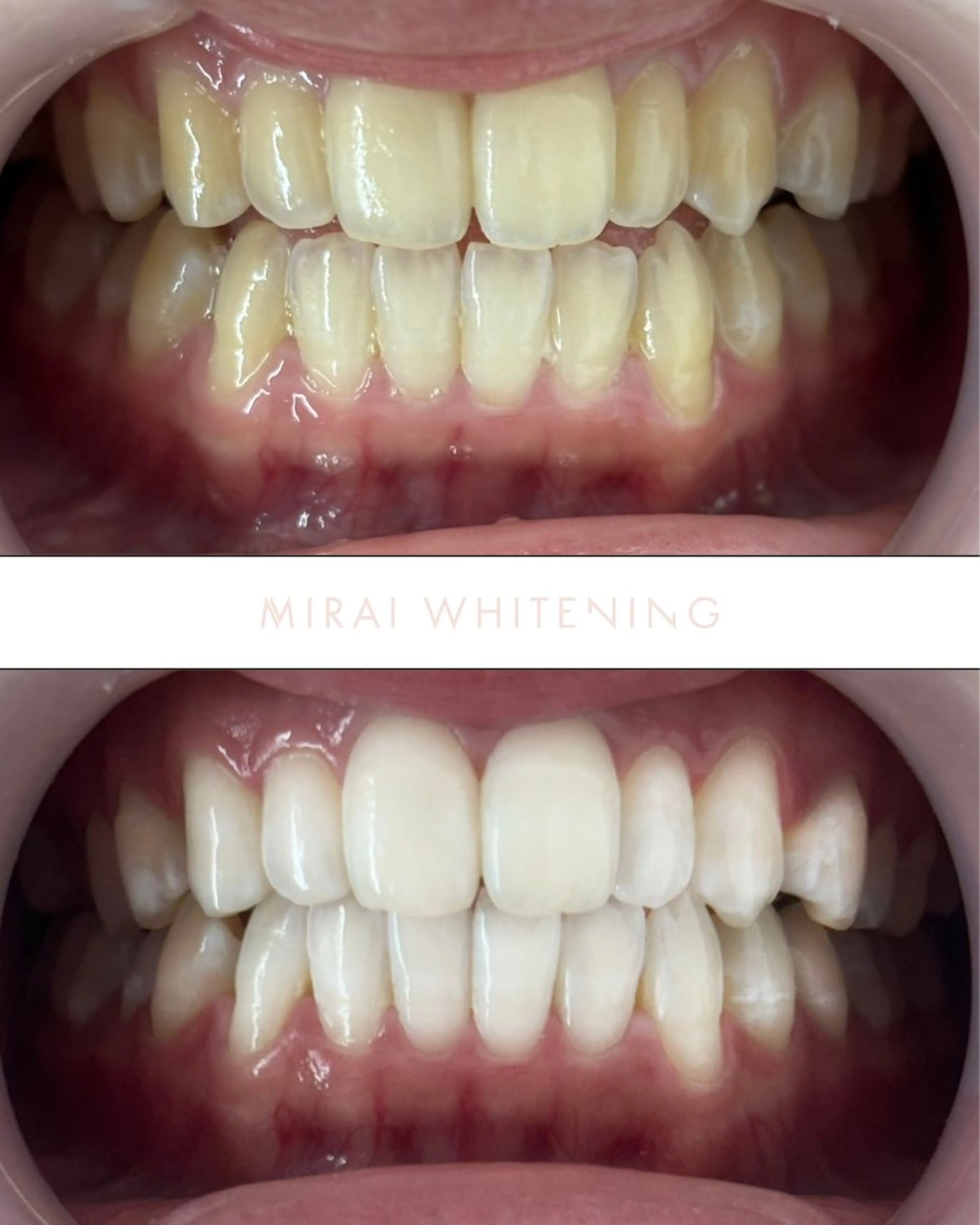 【学割◎初回980円】セルフホワイトニング40分の写真