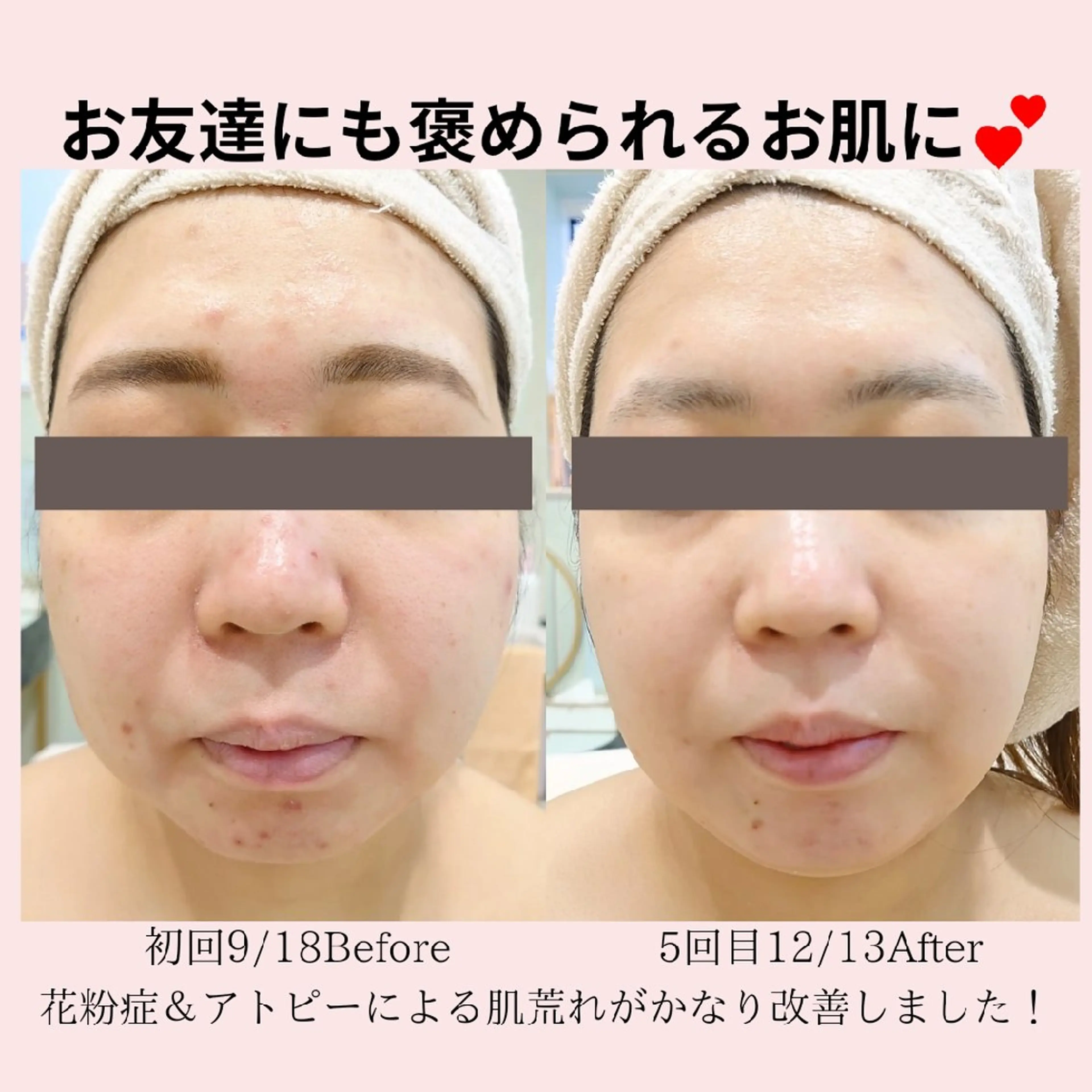 エステ PRETTIEST SHINE所属・山田 浩子のエステ・リラクイメージ