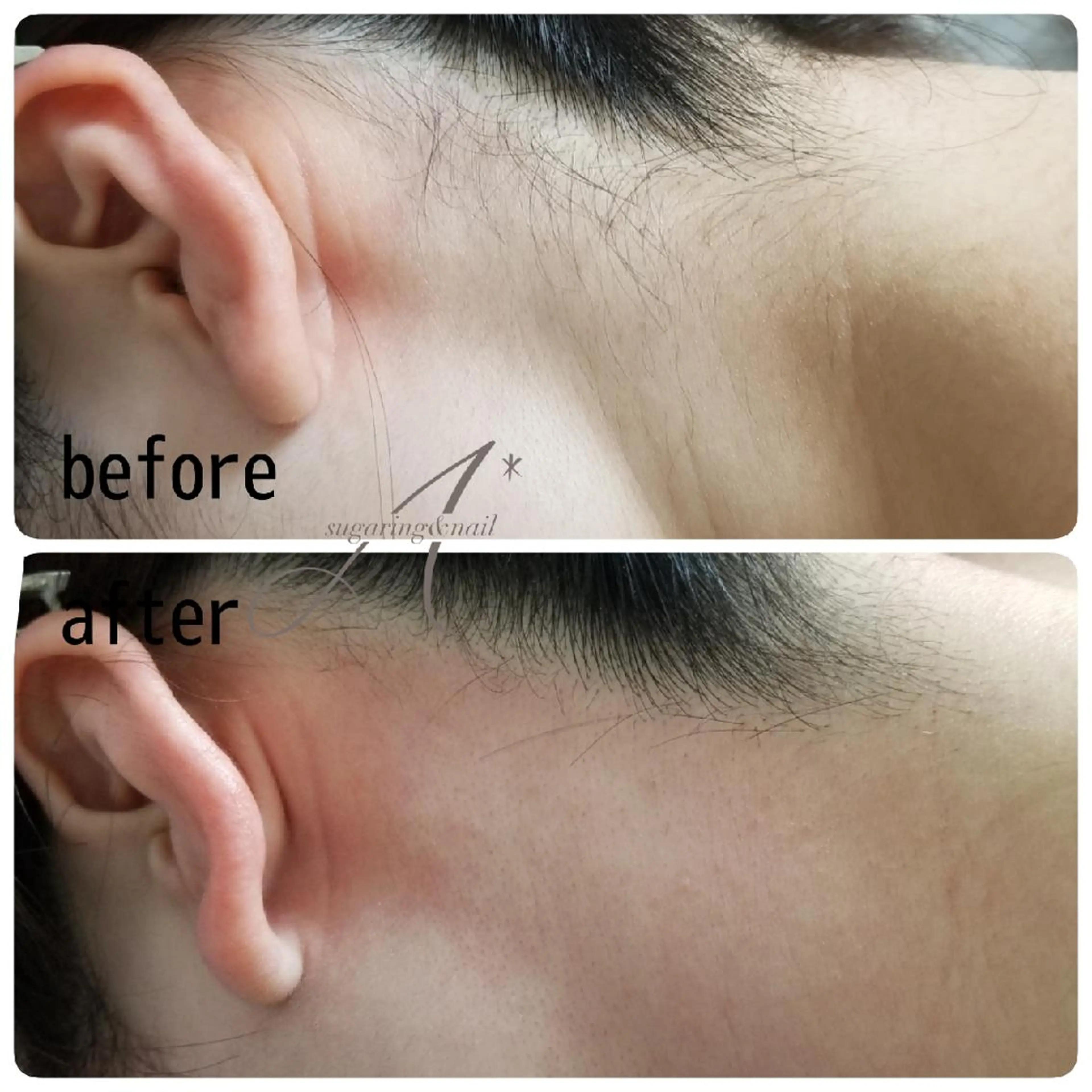 A*[エースター] シュガーリング🍋のエステ・リラクイメージ