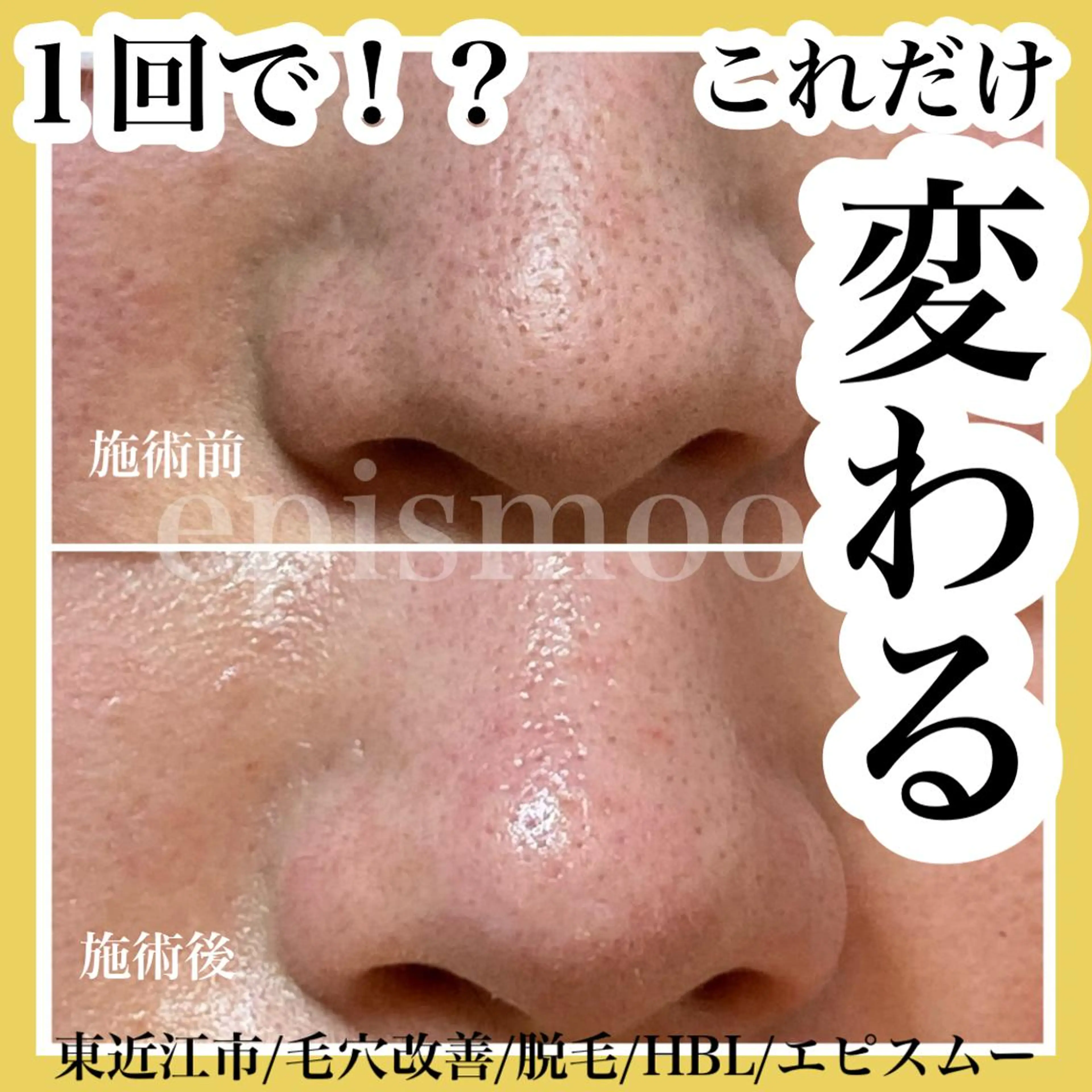 epismoo 脱毛/HBL/毛穴の眉毛・アイブロウイメージ