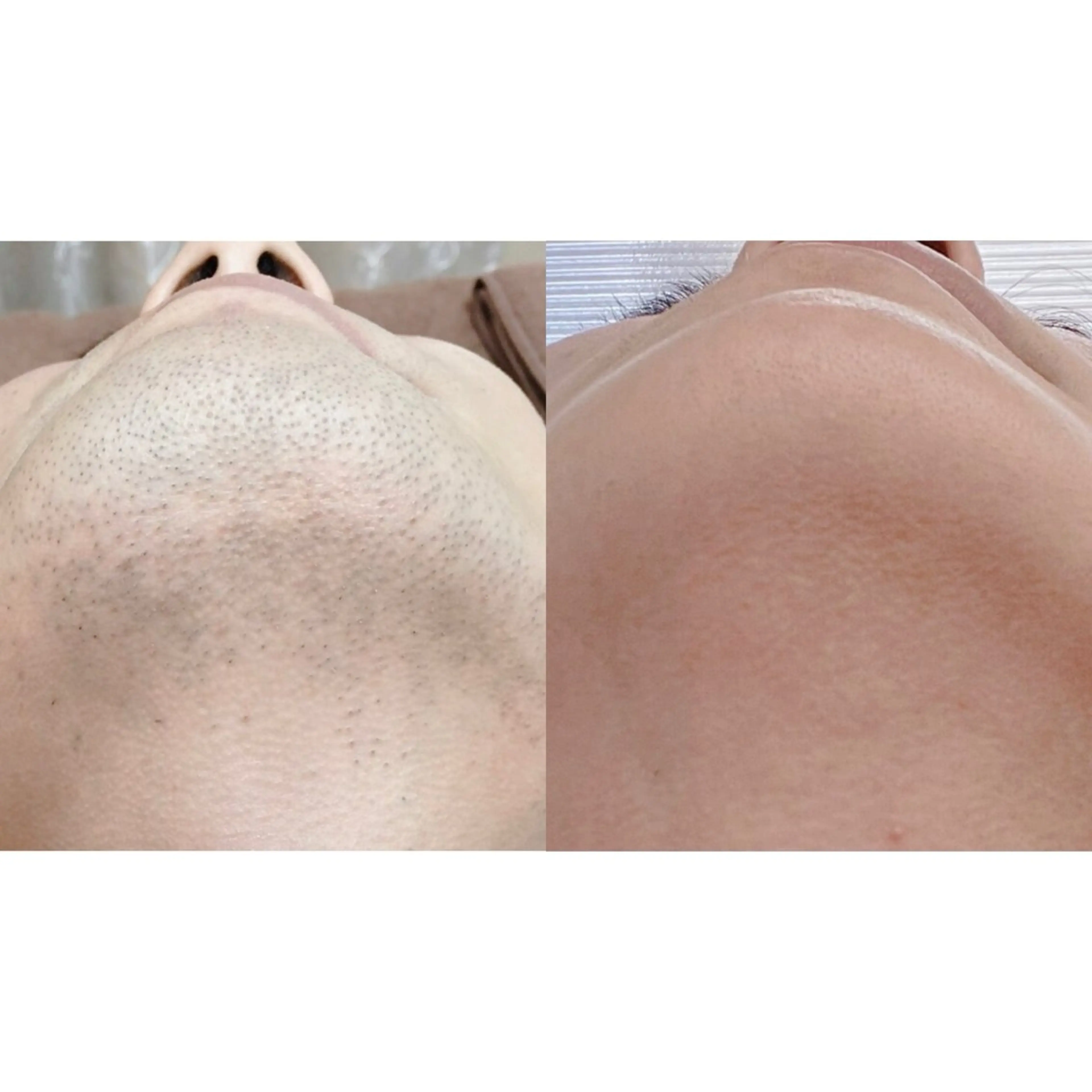 【メンズ限定】ヒゲ脱毛初回体験¥2,200の写真