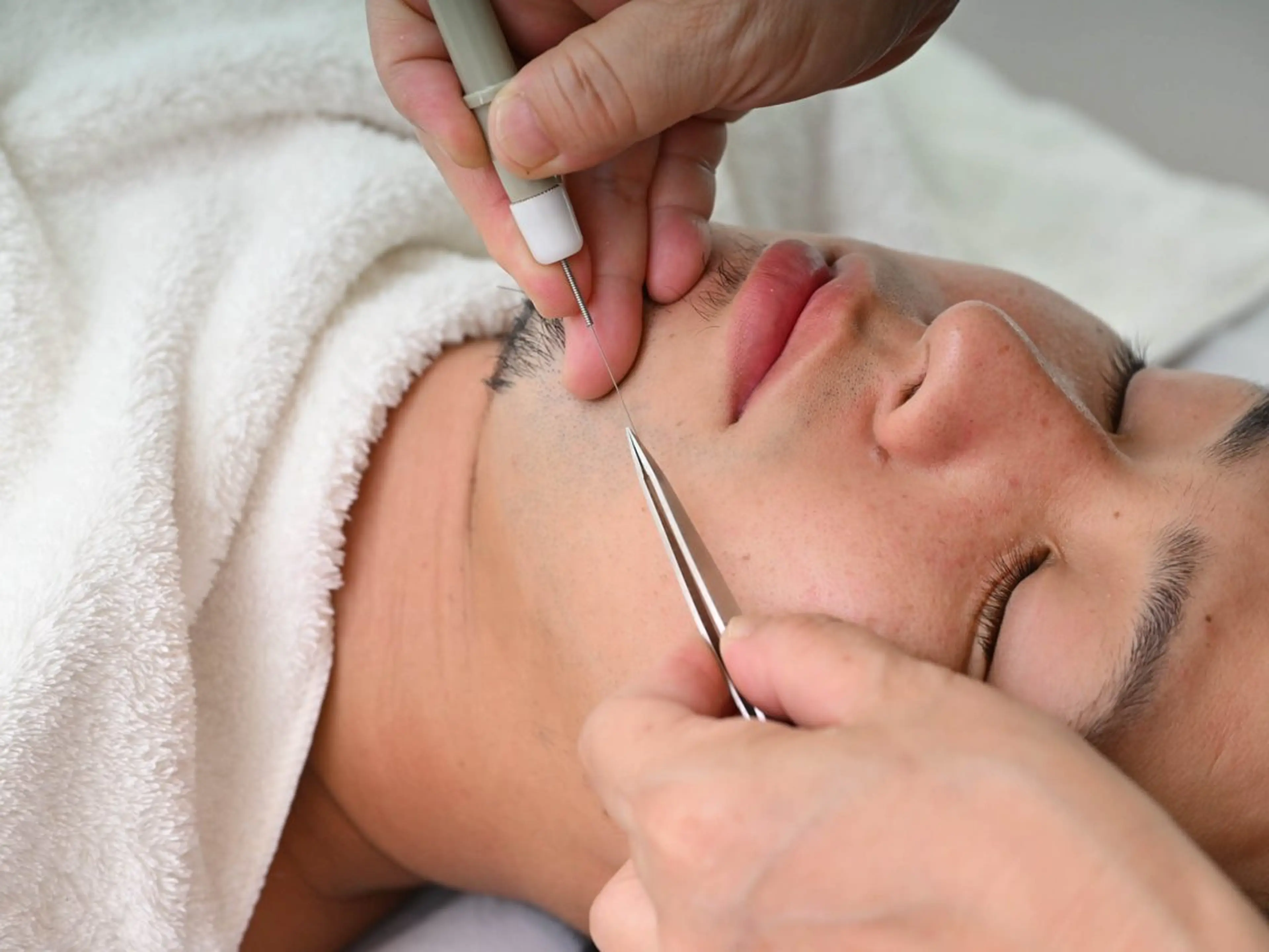 ✨美容電気脱毛モニター男女問わず✨熱解離法一本づつの施術まずはお試し15分3,500円(現金のみ)髭、眉毛、口周りなどの写真