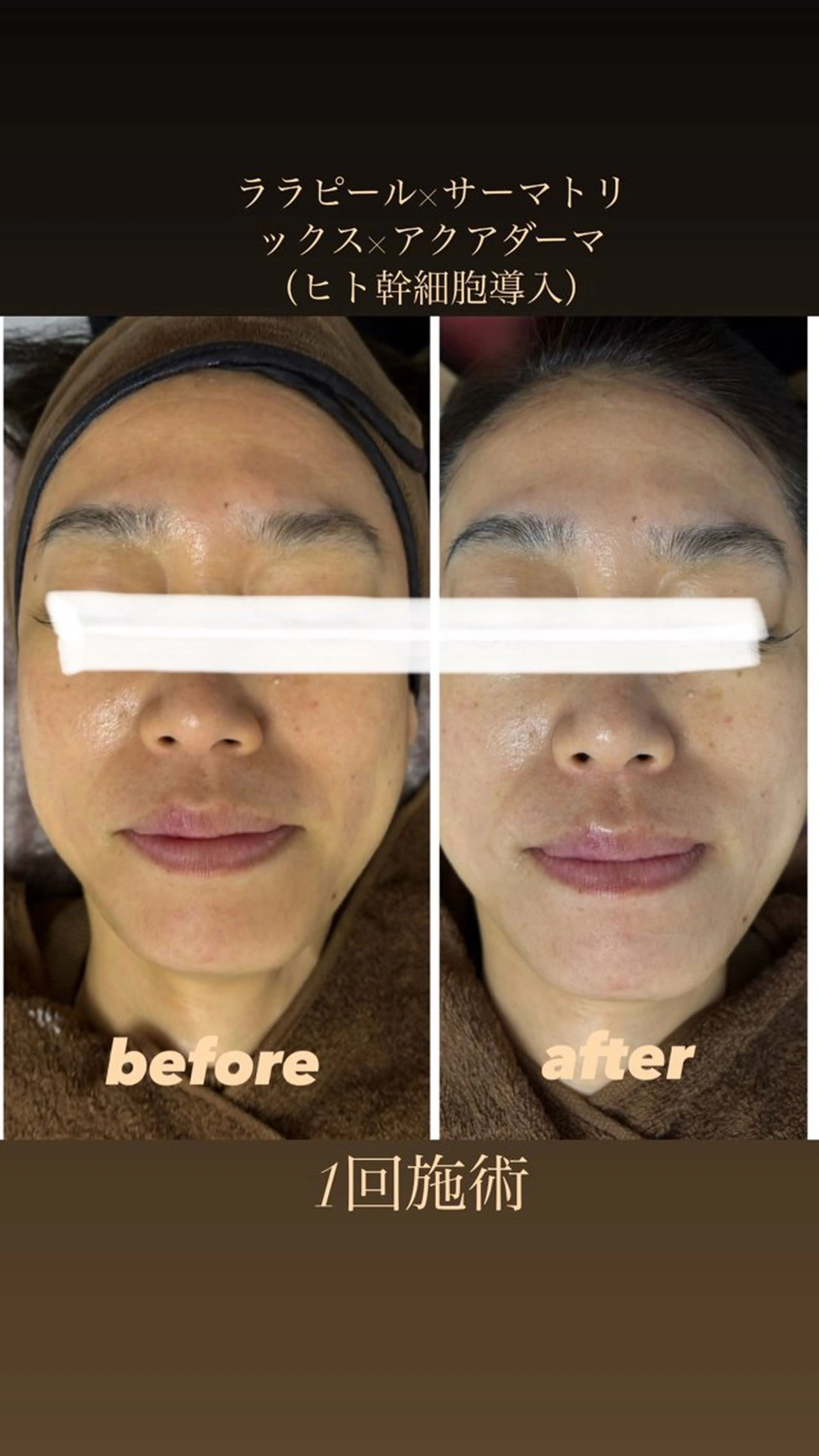 美肌毛穴ケア/看護師 🌷ナスサロmanaのエステ・リラクイメージ