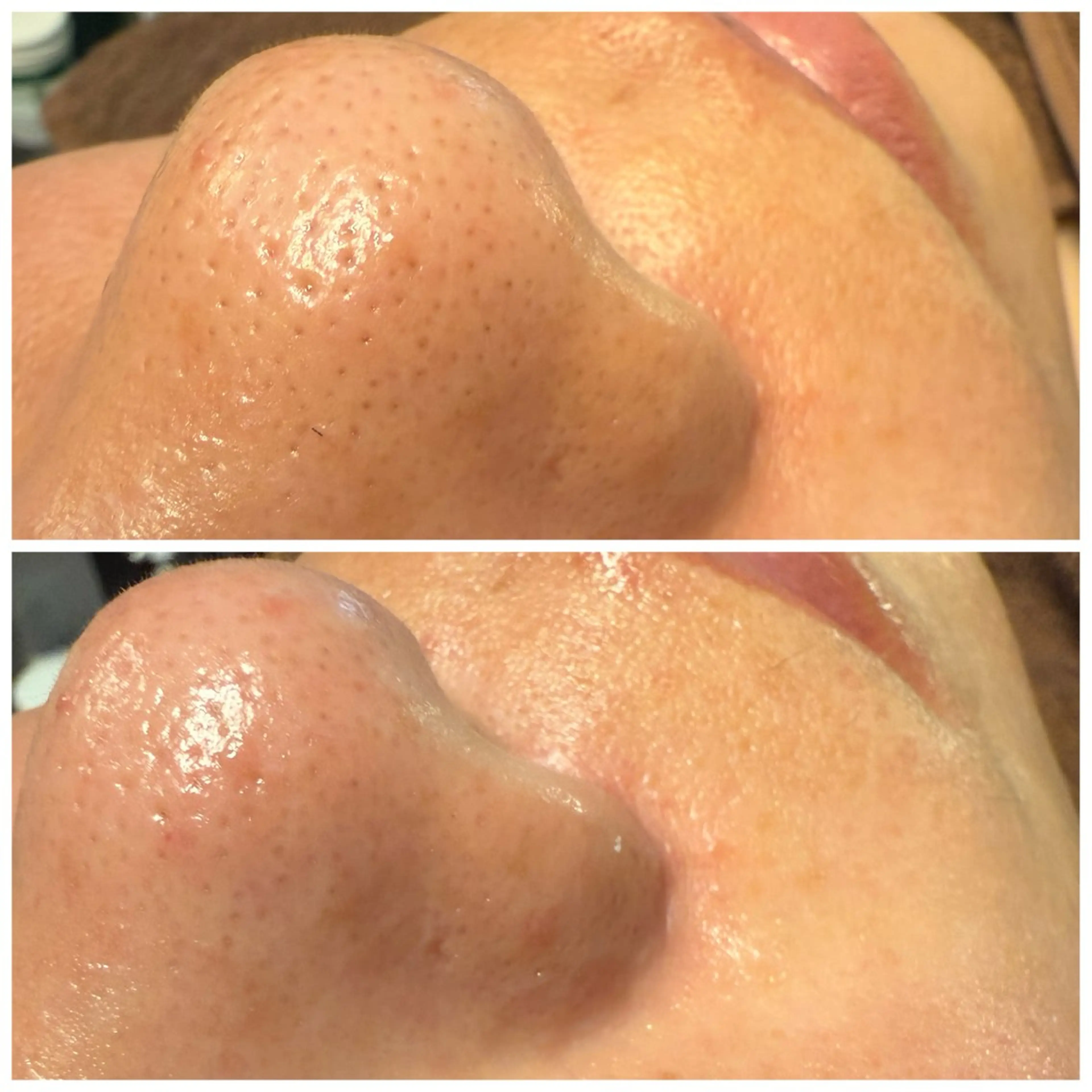 【毛穴ケア】毛穴や角質のザラつき気になる方におすすめ◎の写真