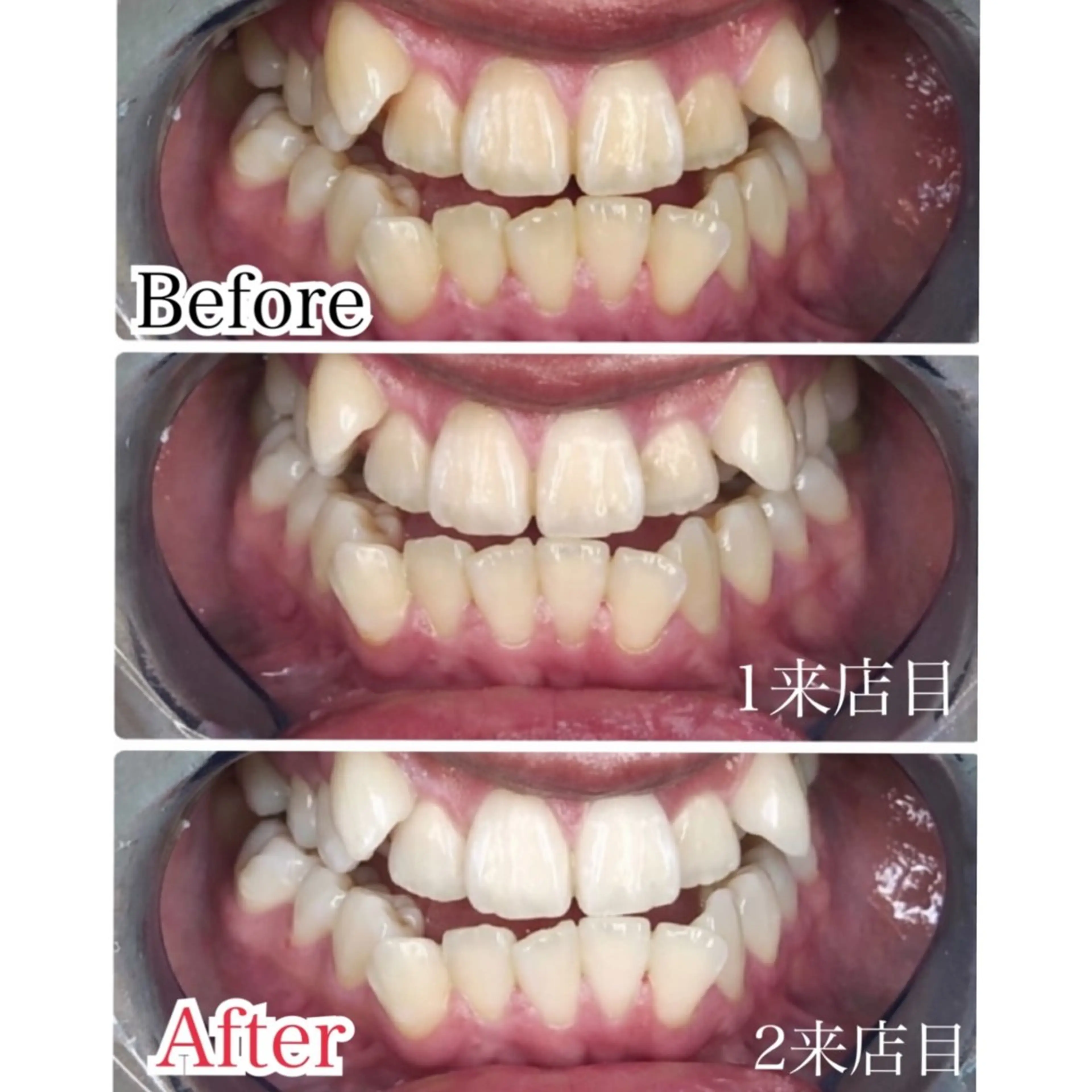 【結婚式・前撮り】プレミアムホワイトニング💁‍♀️<合計80分照射2来店>の写真