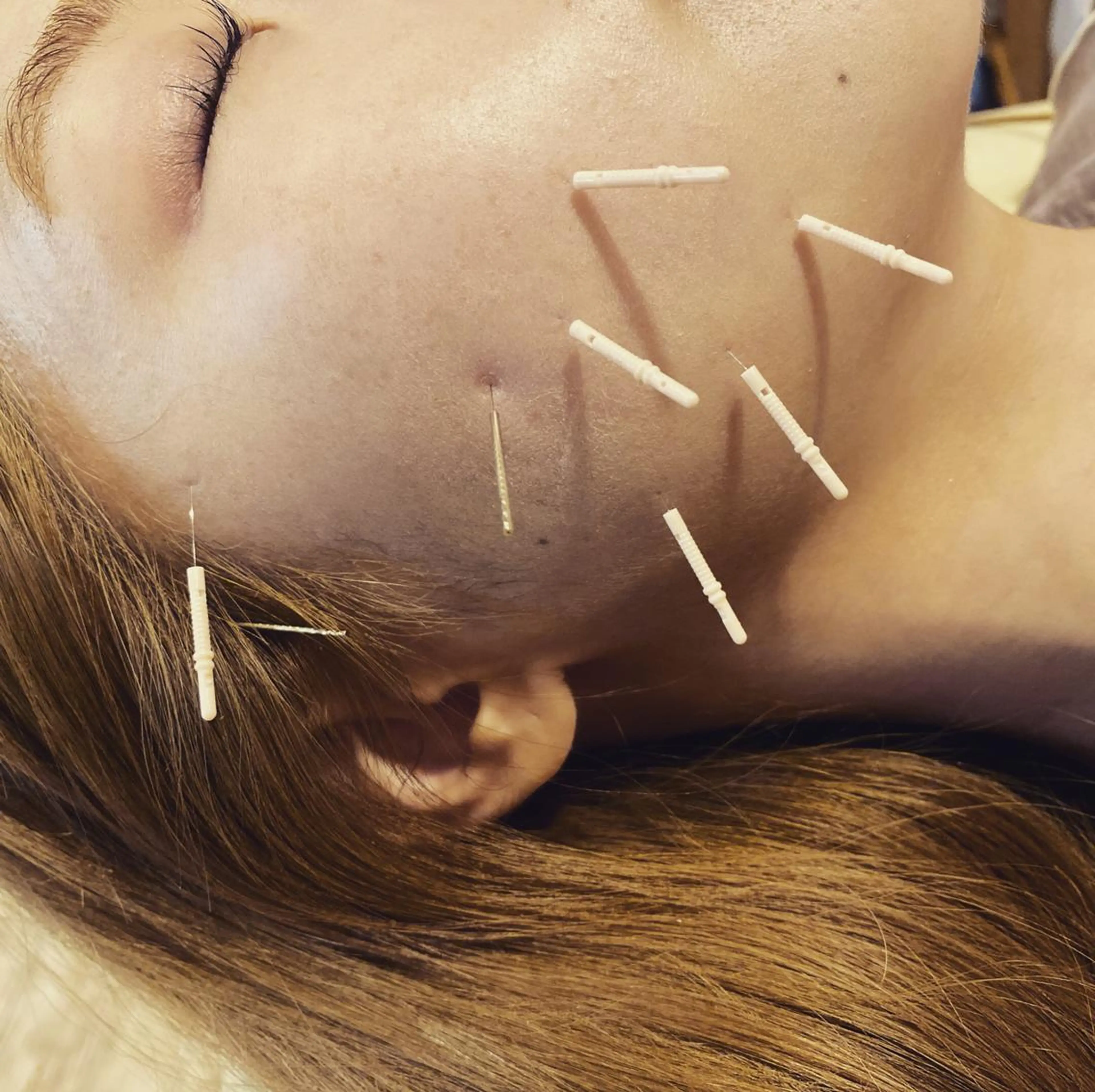 むくみたるみ専門☆ 美容鍼・小顔矯正のエステ・リラクイメージ