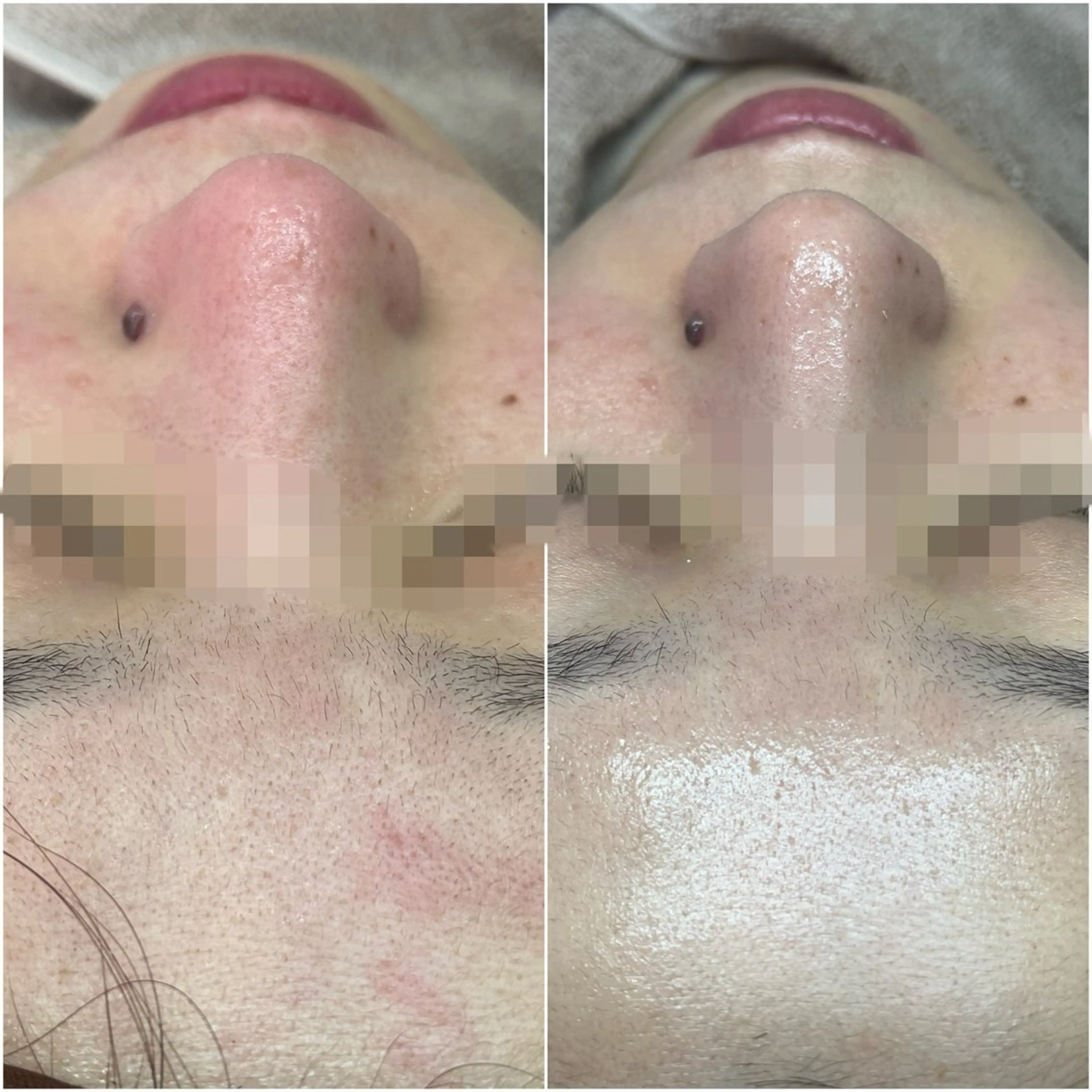 3 月限定❤️特別体験✨ハーブピーリング➕鎮静保湿パックの写真