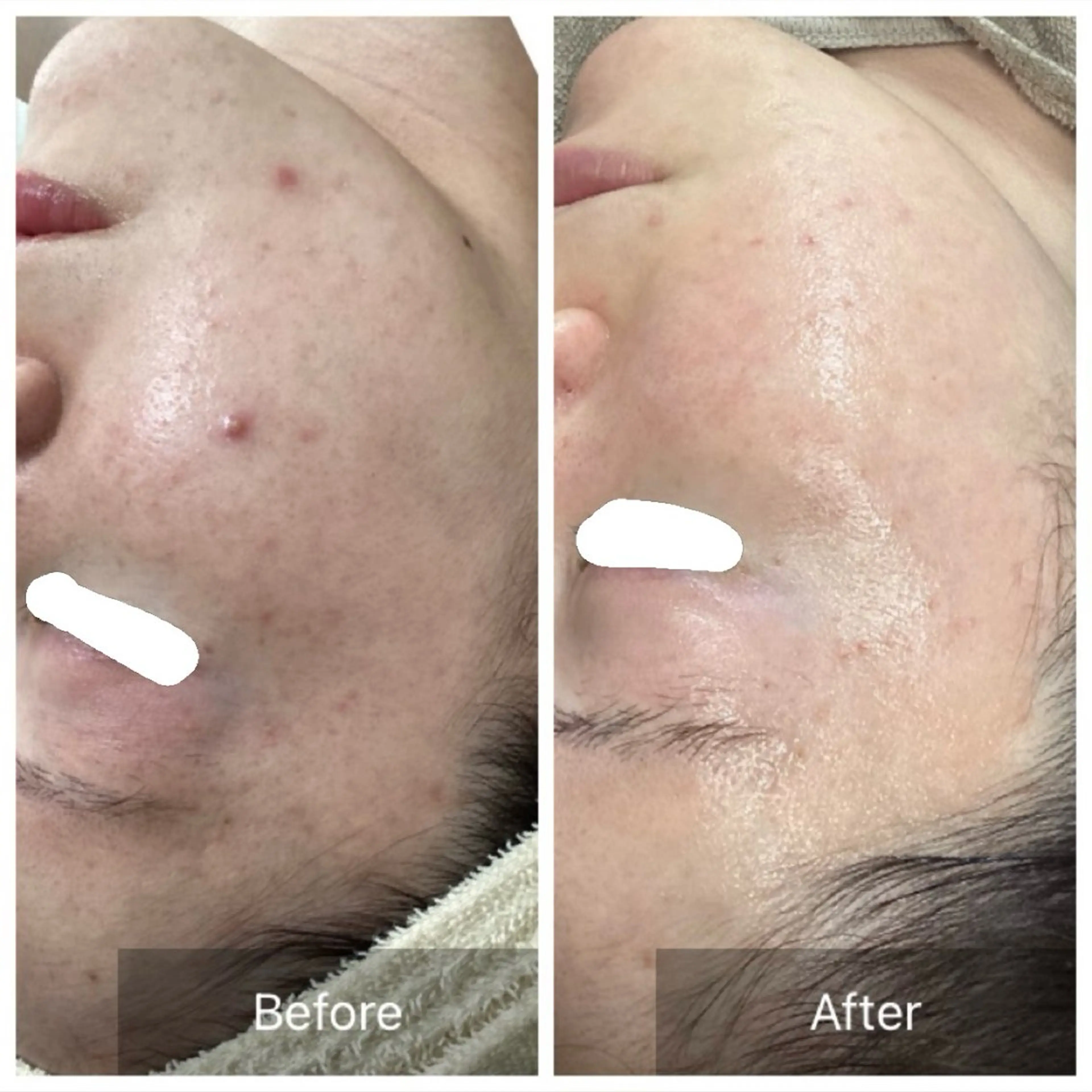 【年齢によるくすみ/ハリ/シミ/たるみ】30代からの最新✨肌管理🇰🇷プラピール＋お悩み別アンプル導入の写真