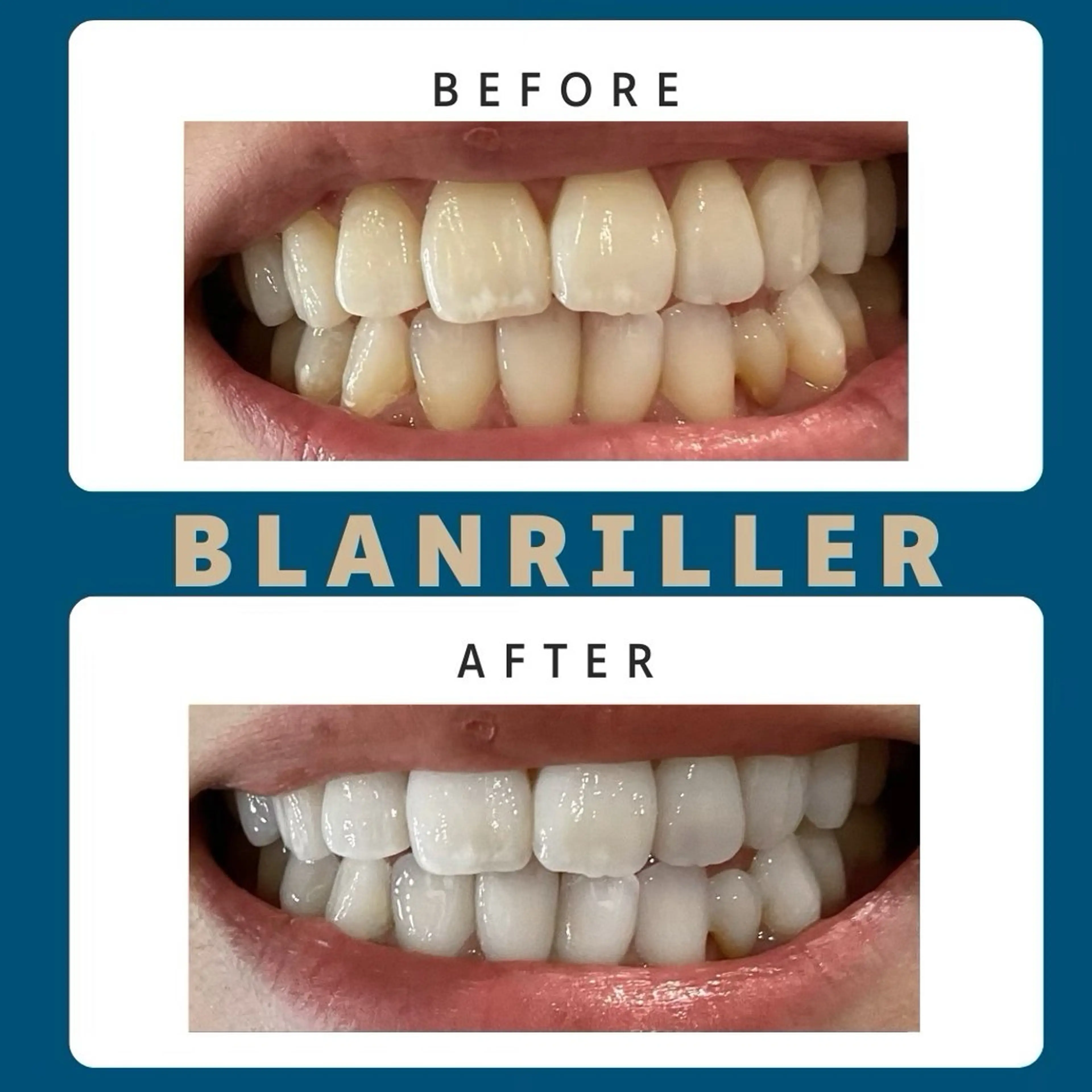 【8回＊回数券】セルフホワイトニング15分×2回 8日分 通常¥40000→¥30000の写真