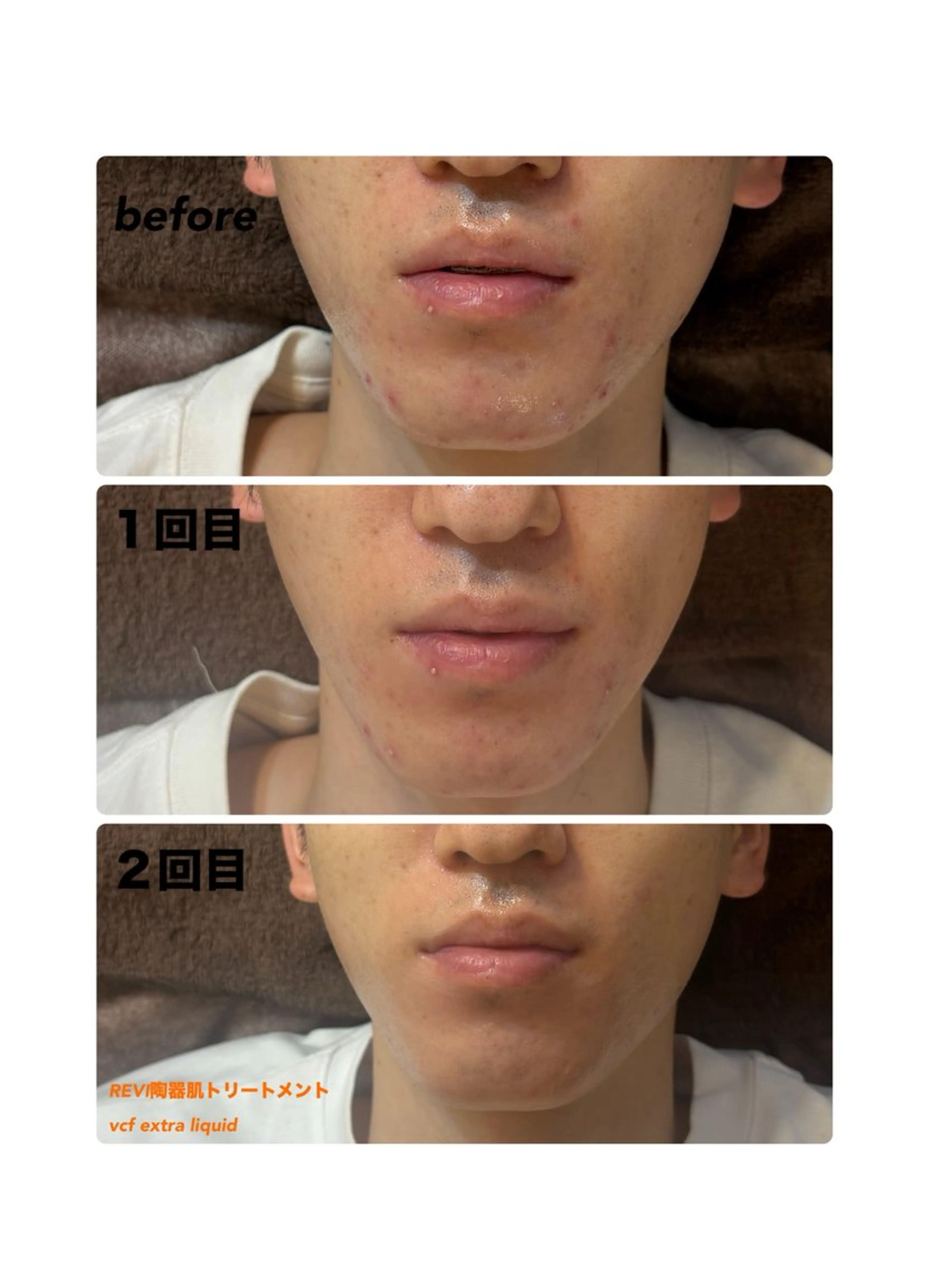 エステ ハーブピーリング/韓国肌管理/フェイシャル/毛穴洗浄/眉毛/顔脱毛【糸脱毛専門】rev所属・ハーブピーリング🌹 毛穴洗浄❤️眉waxのエステ・リラクイメージ