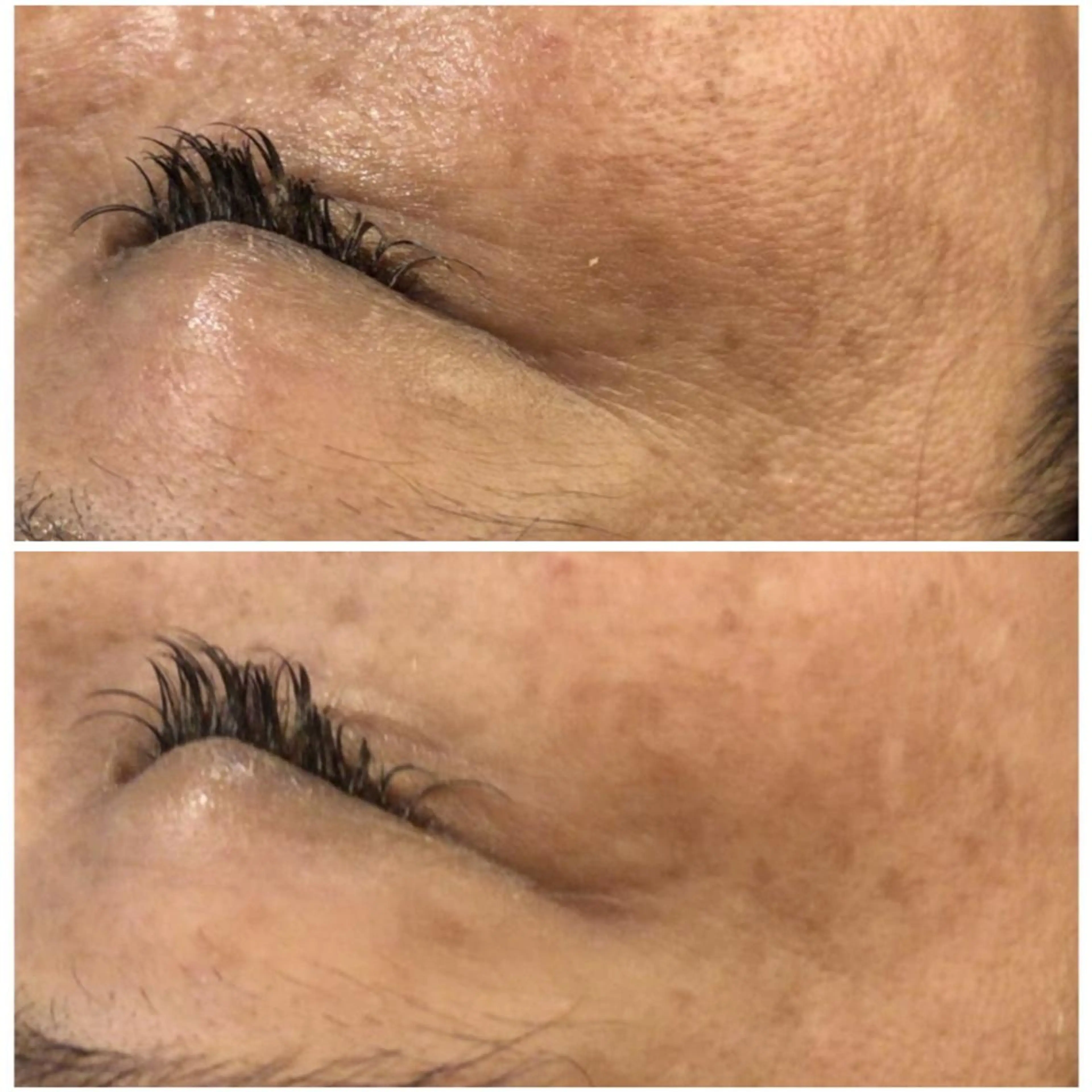 エステ リラク 都内で出来る肌管理！ 最短ニキビ改善のエステ・リラクイメージ