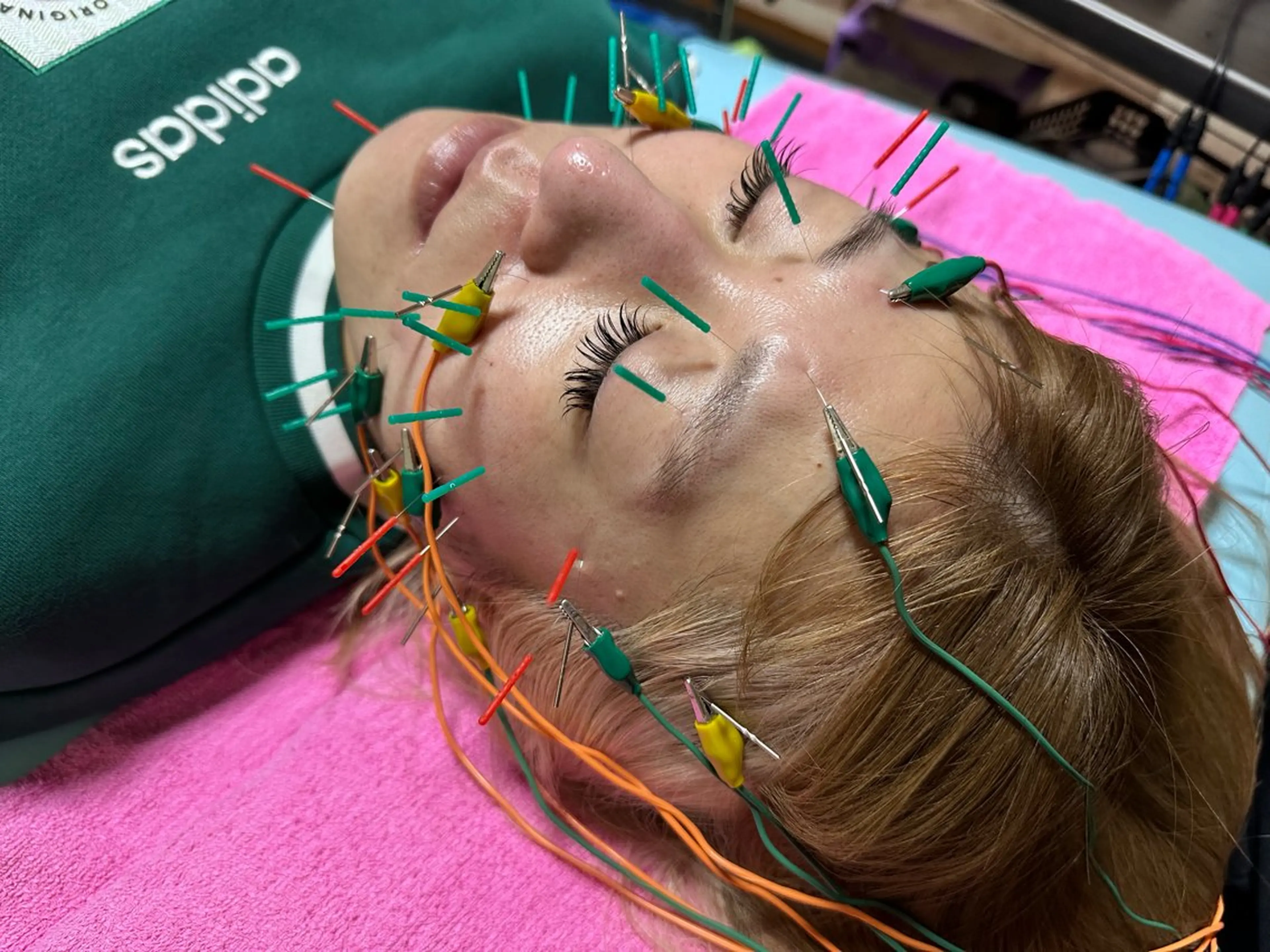 ✨12月限定✨ 美容鍼コース たるみシワ予防 お試し 50分 メンズも大歓迎 通常10,000円⇒5,000円の写真