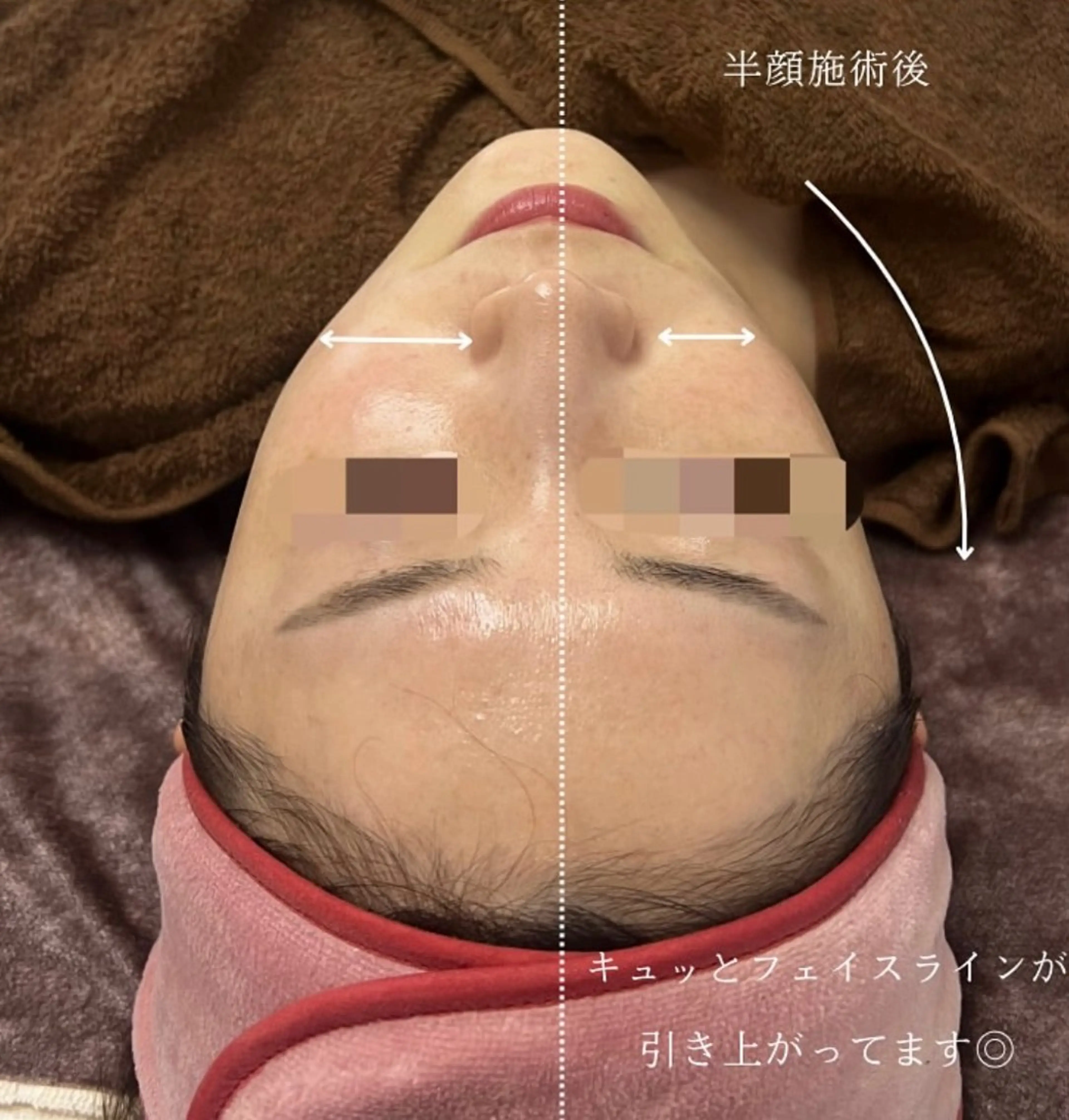 【サーマトリックス🌟 】シワ・たるみ改善・毛穴引き締め・小顔効果！👀の写真