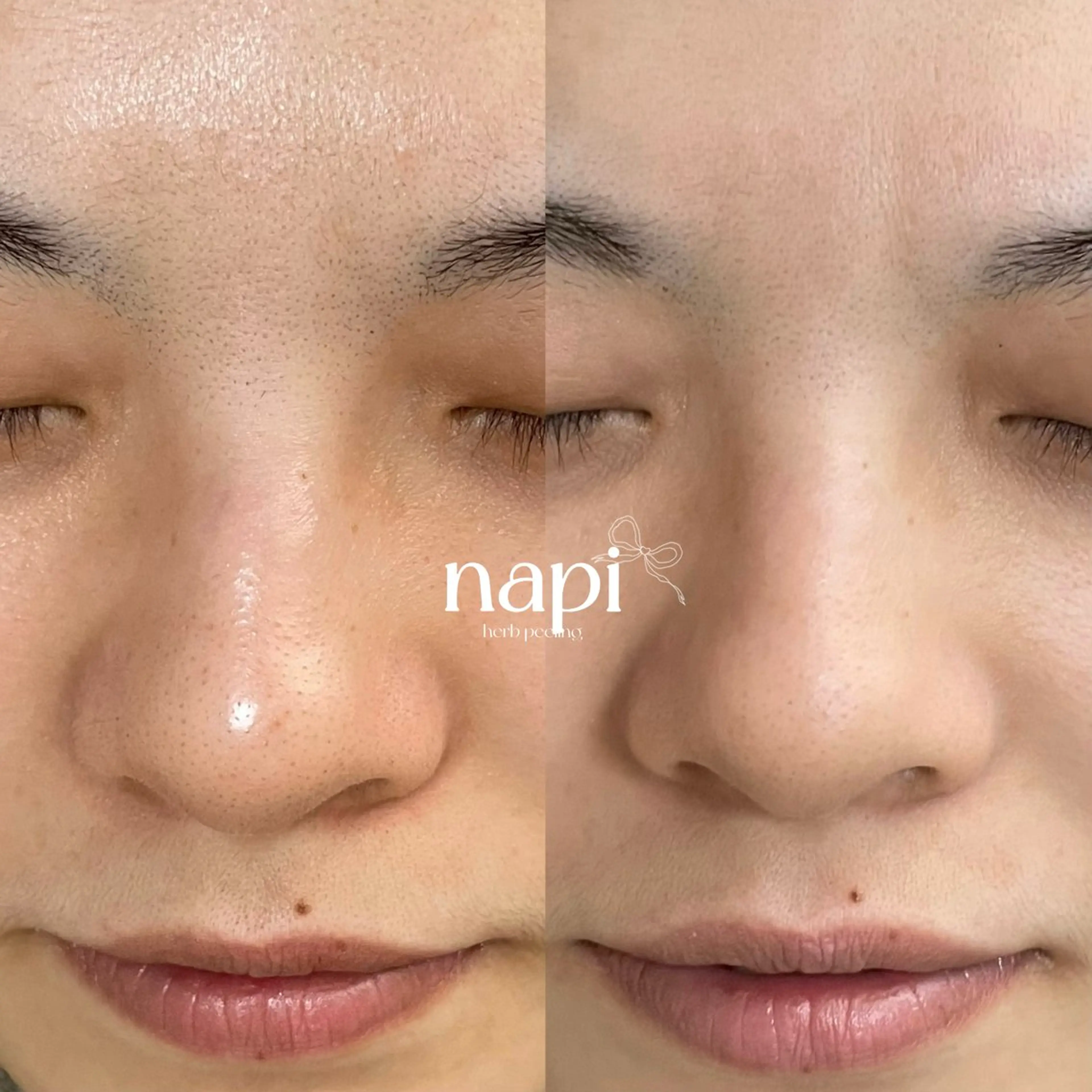 フェイシャルハーブピーリング🌿の写真