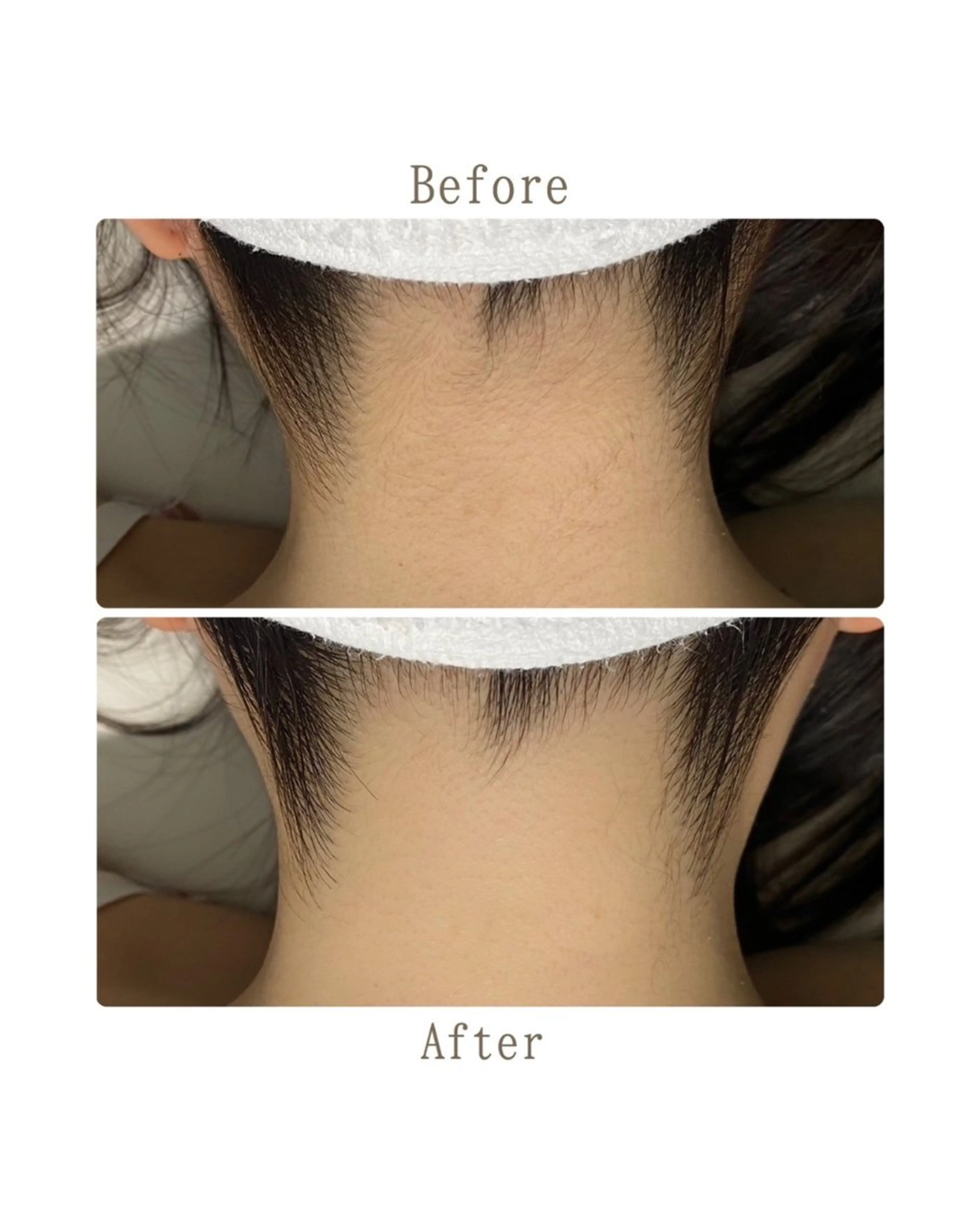 【 脇＋うなじ＋背中上脱毛🫧 】水着/前撮り/ウエディング/卒業式/入学式の写真