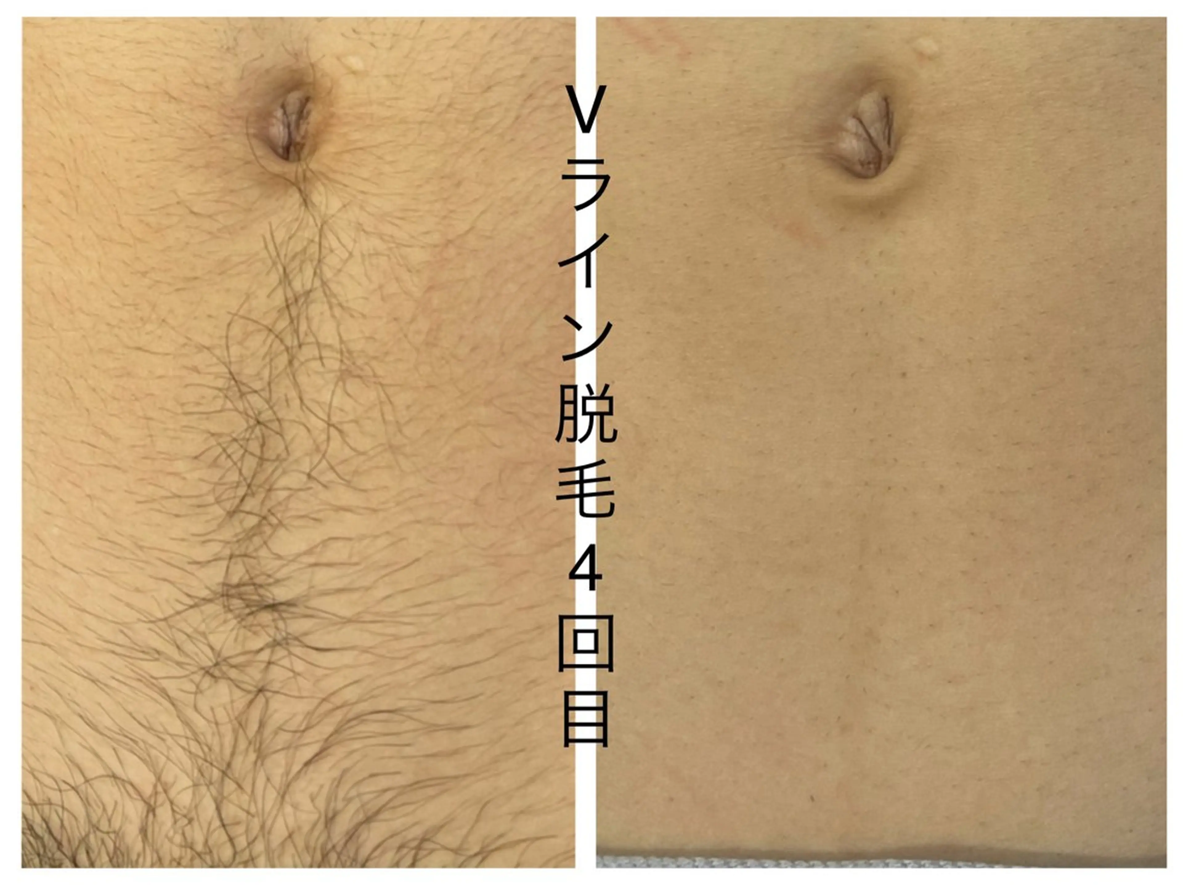 メンズ 学生（メンズ向け） 医療提携メンズ脱毛 CDFAkasakaのエステ・リラクイメージ