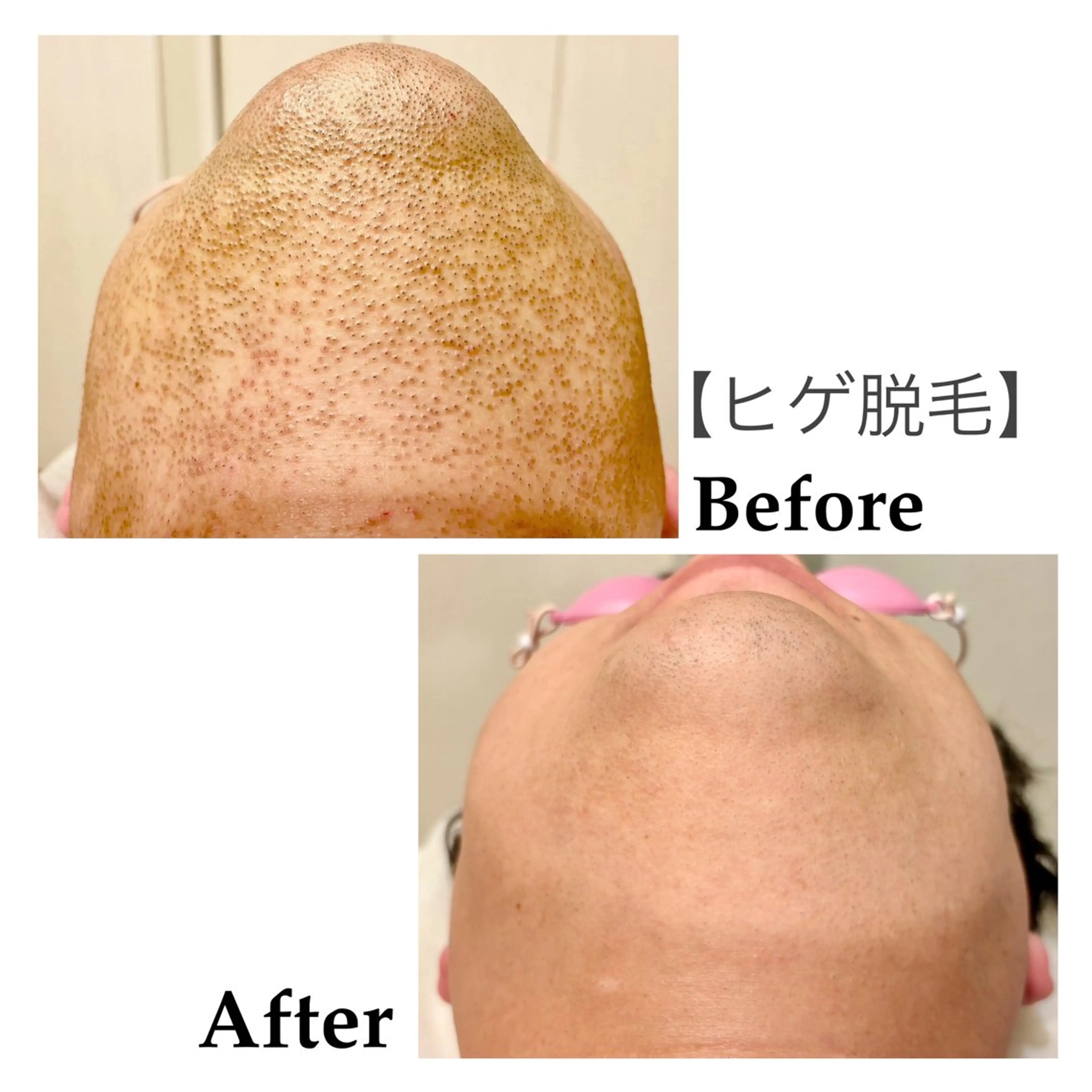 メンズ 脱毛 脱毛サロンFIS【新宿店】所属・堺 祐季奈のエステ・リラクイメージ