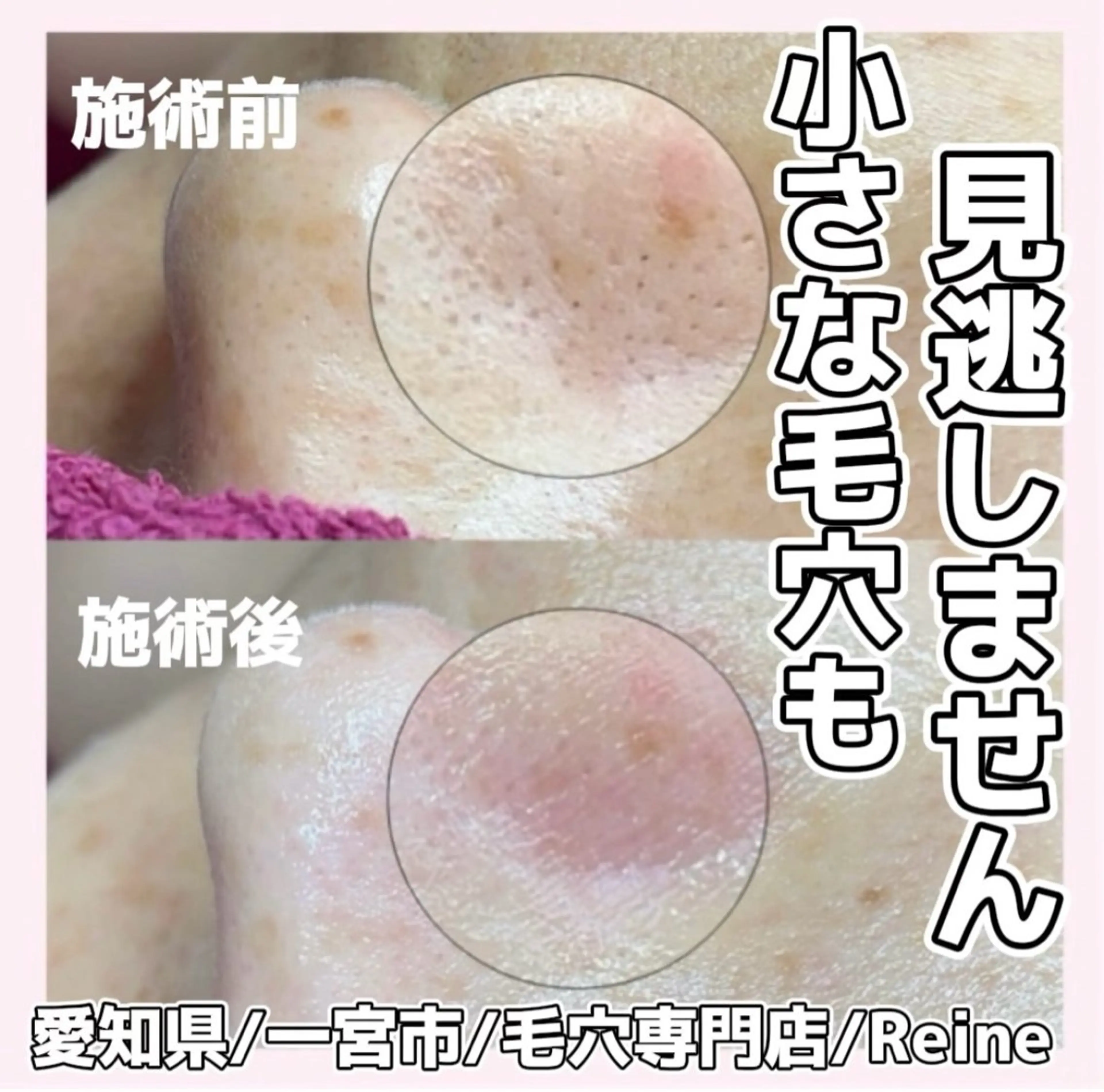 エステ Reine BeautySalon所属・毛穴/シミ肝斑/脱毛 横山梨里のエステ・リラクイメージ