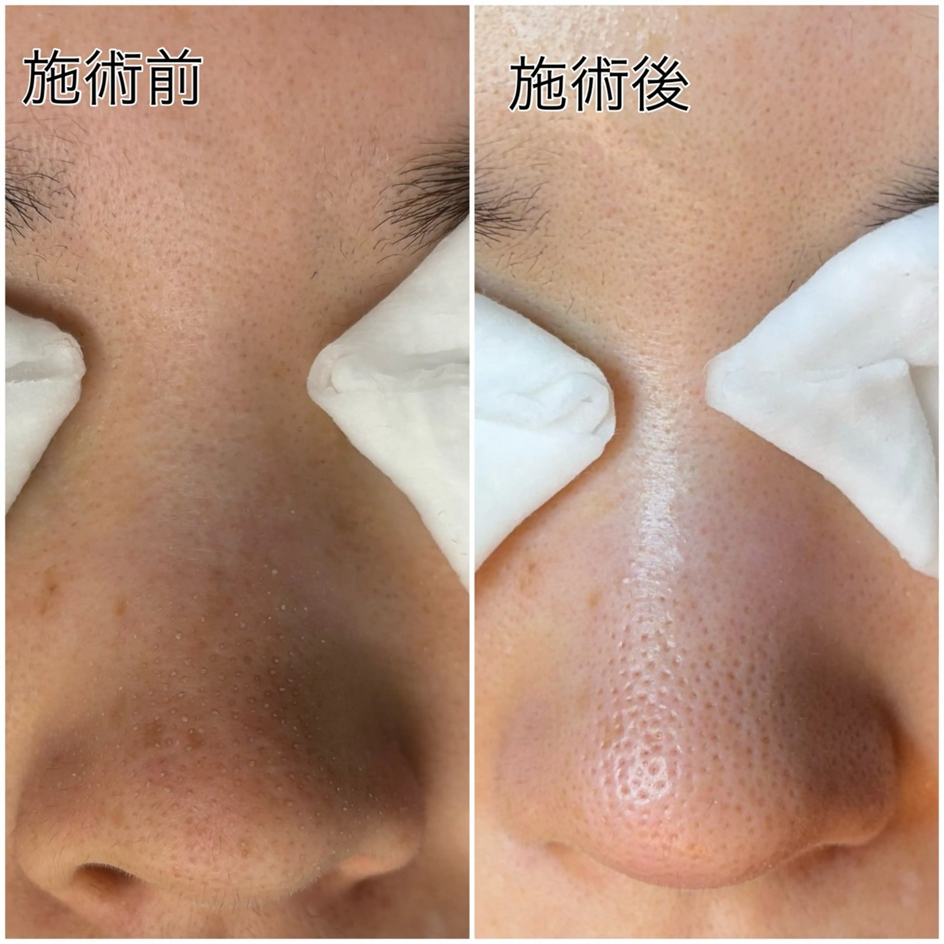 [リピーター様限定]毛穴コースの写真