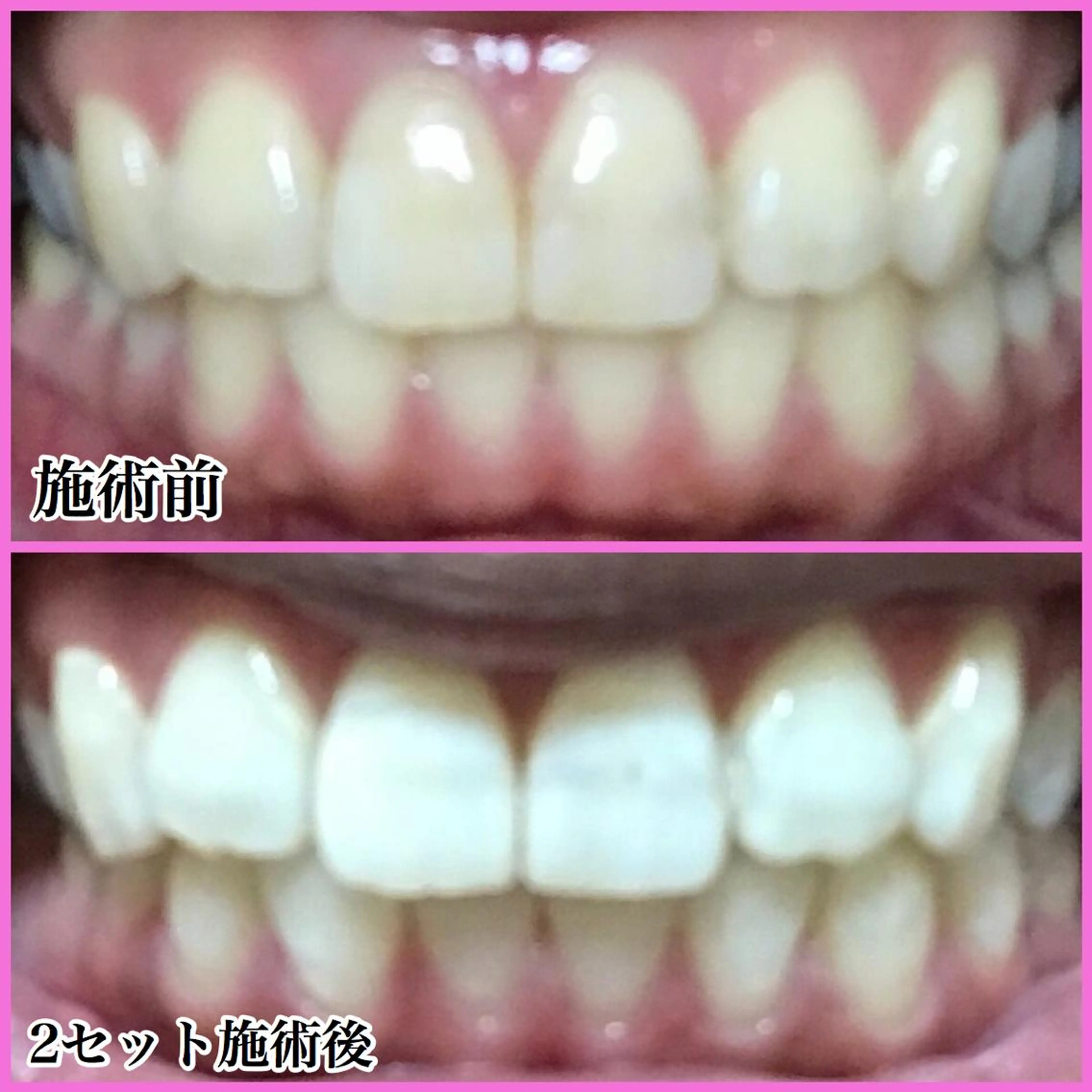 ネイル/耳つぼ /新ホワイトニングのネイルデザイン