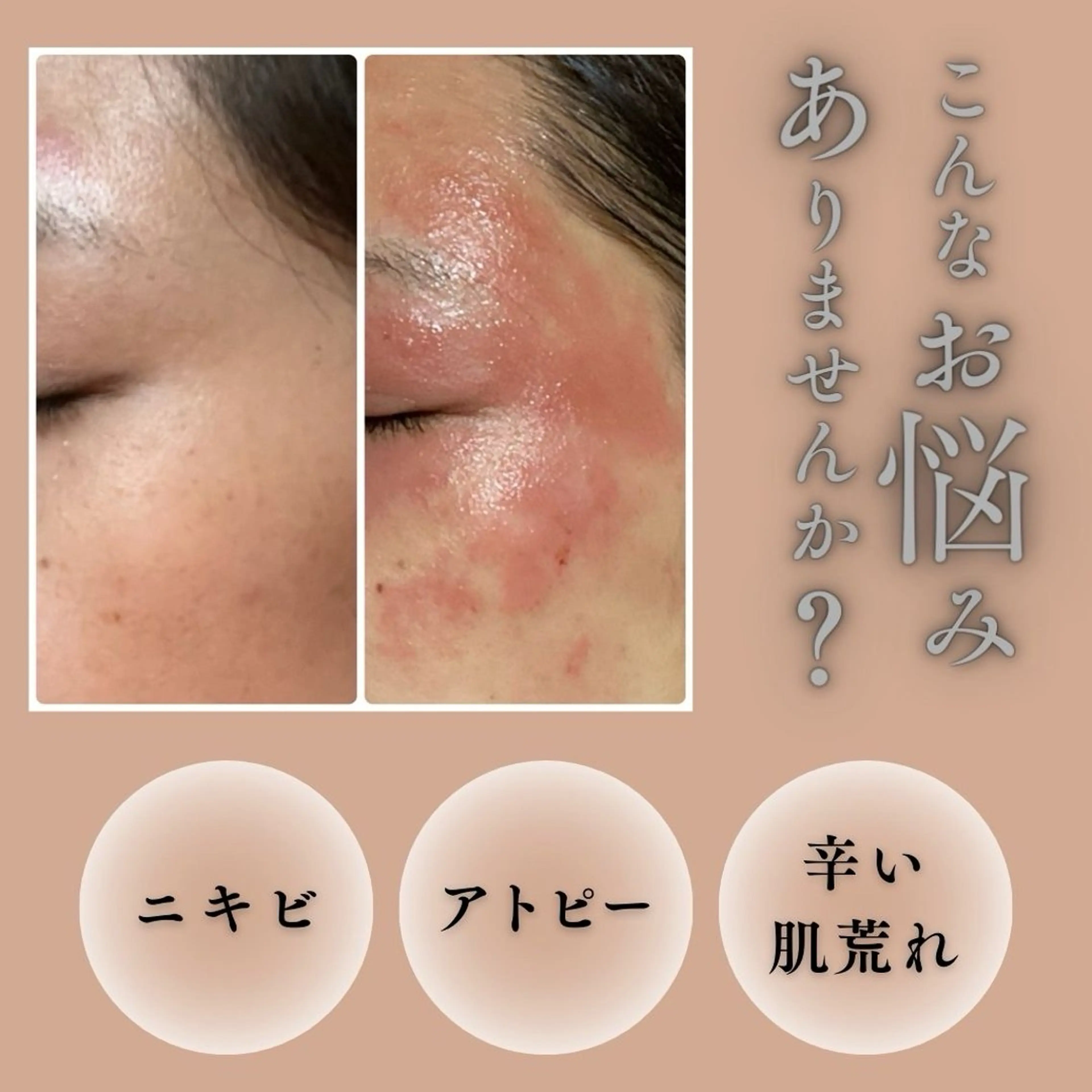 【敏感肌さん必見】剥けないハーブピーリング＋再生因子の写真